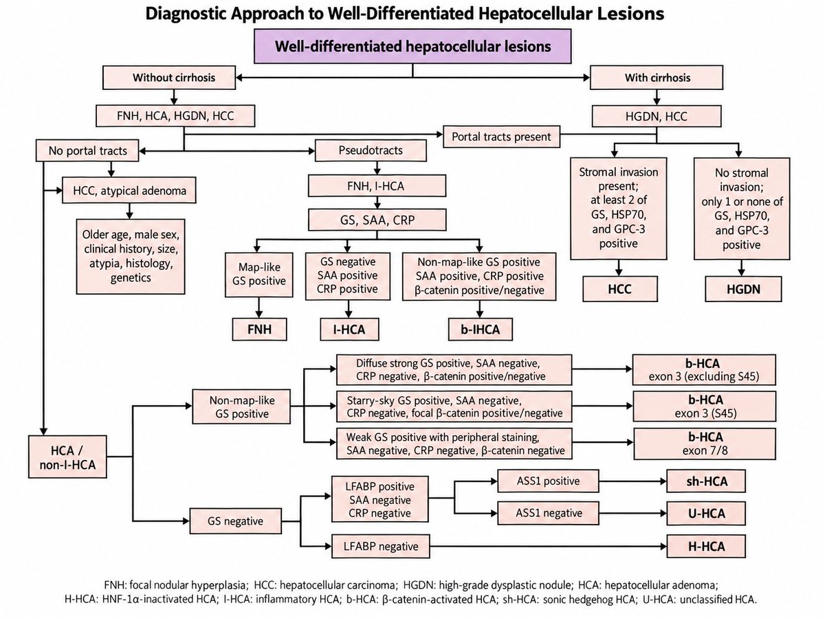 DrHou_pathology's tweet photo. Diagnostic Approach to Well-Differentiated Hepatocellular Lesions

For well-differentiated hepatocellular lesions, the recommended initial panel includes reticulin stain, CK7, and CD34.

When distinction between a dysplastic nodule (DN) and hepatocellular carcinoma (HCC) is required, additional markers may include GS, Glypican-3 (GPC-3), and HSP70.

When hepatocellular adenoma (HCA) is suspected and subtyping is required, an additional immunohistochemical panel may include GS, β-catenin, SAA, CRP, L-FABP, ASS1, and PTGDS.