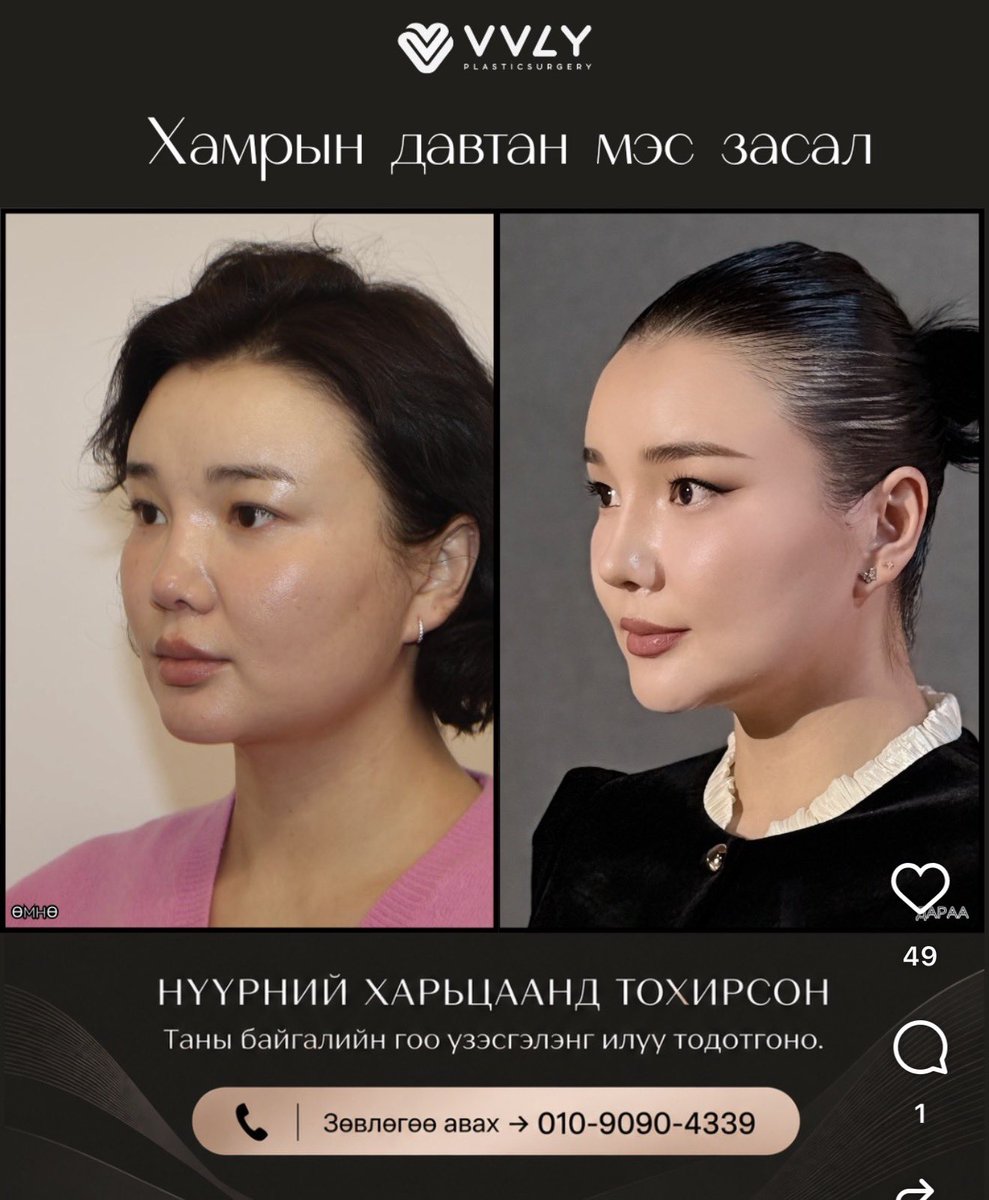 gerelchimeg007's tweet photo. Хүүхнүүд гоо сайхны реклам хийхдээ бодолтой хандах хэрэгтэй. Үнэгүй гэж гүйж очоод хулхи баталгаагүй хачин юм хийдэг эмнэлгүүдийг рекламдаад байж болохгүй!Жүжигчин Золоо NANA гэж Солонгос эмнэлэгт хамраа засуулаад аймар хамартай болсон ч энэ эмнэлгээ рекламдсаар бсн. Одоо гэтэл? https://t.co/WAeP7sVhRW