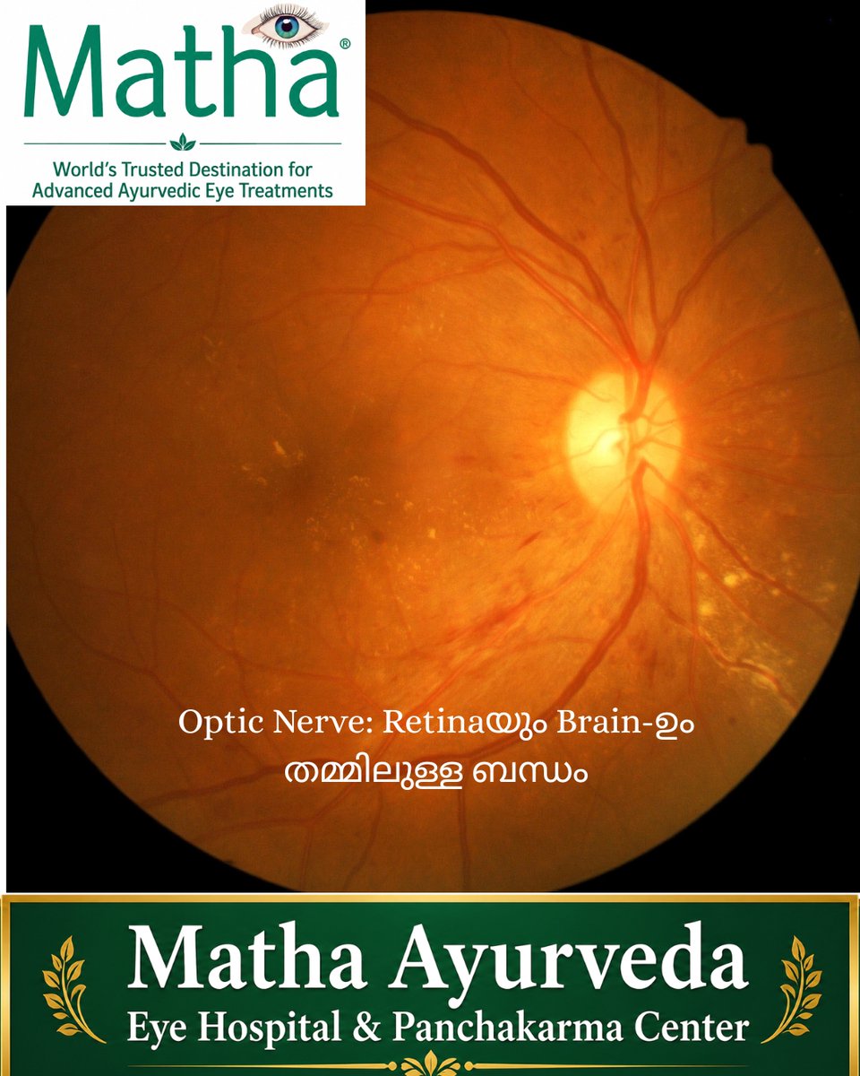 arunjithp's tweet photo. Optic nerve എന്ന് പറയുന്നത് retinaയിൽ നിന്നുള്ള nerve fibres-ന്റെ continuation ആണ്. Retinaയിലെ നിരവധി nerve fibres ഒരുമിച്ച് ചേർന്ന് ഒരു bundle രൂപത്തിലാണ് optic nerve ഉണ്ടാകുന്നത്.

കണ്ണും brain-ഉം തമ്മിലുള്ള ബന്ധം മനസ്സിലാക്കുമ്പോൾ, retinaയെ brain-ന്റെ ഒരു extension ആയി കണക്കാക്കാം. അതുകൊണ്ട് കണ്ണിൽ നിന്ന് brain-ലേക്ക് മാത്രം പോകുന്ന ഒരു connection എന്നതിലുപരി, brain–retina–optic nerve എന്നിവ തമ്മിലുള്ള തുടർച്ചയായ neural connection ആയി ഇതിനെ മനസ്സിലാക്കുന്നതാണ് കൂടുതൽ ശരി.

Click here to watch>>>>https://t.co/WRN9NzJLVx