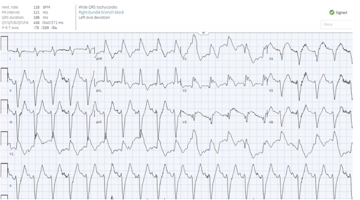 heartsECGcourse's tweet photo. 75 year-old with sudden shortness of breath. What’s the cause of the wide complex tachycardia? 

#ECG #EKG #cardiotwitter 

https://t.co/4YifdX7m26 https://t.co/dpwCGV6dc9