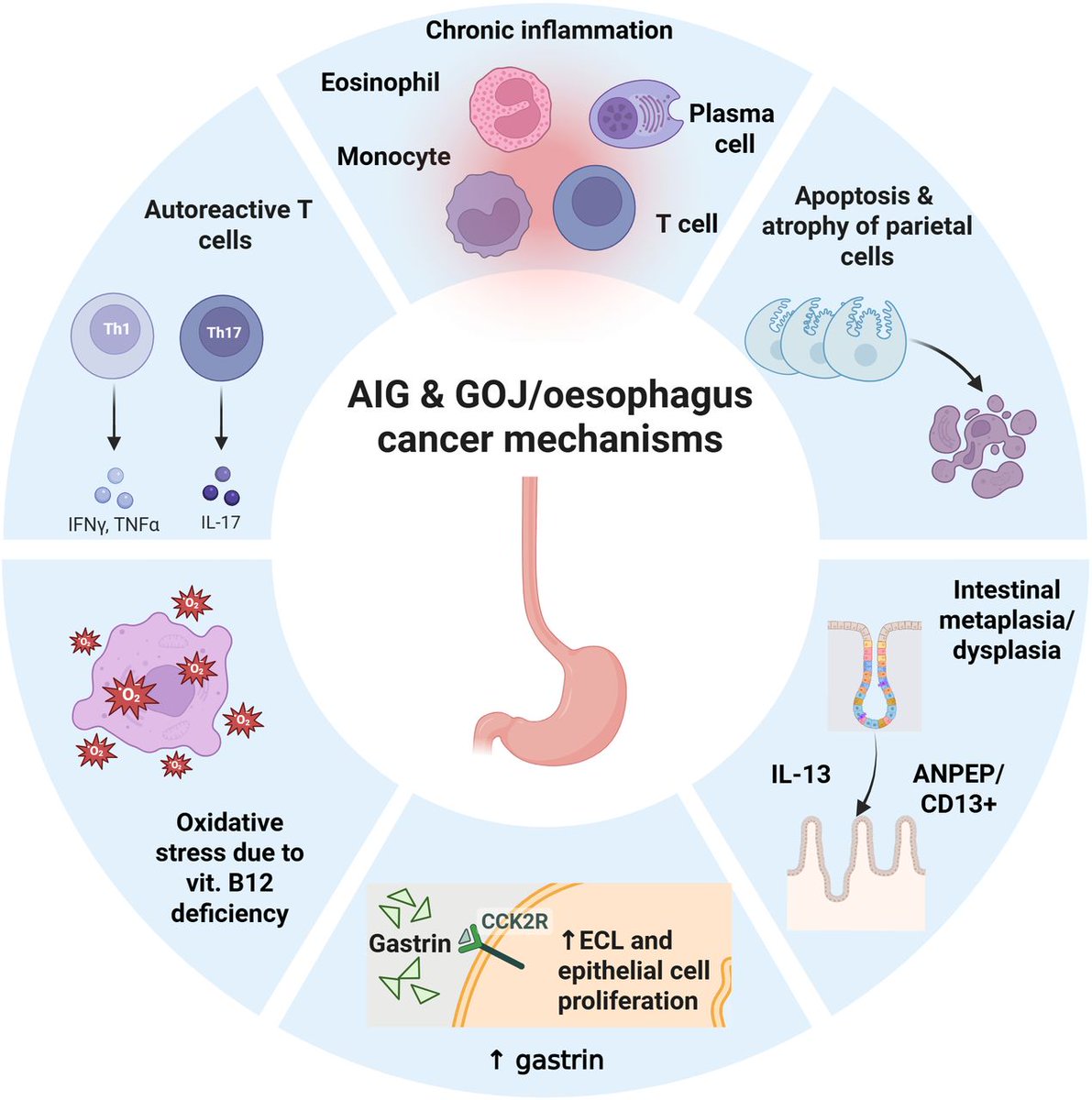 Gut_BMJ's tweet photo. Autoimmune gastritis has traditionally been viewed mainly as a risk factor for gastric neuroendocrine tumours and non-cardia gastric adenocarcinoma. But could its cancer risk extend further?

Read the #RecentAdvancesInClinicalPractice #GUTRecentAdvancesInClinicalPractice by Lenti et al. entitled “Autoimmune gastritis: a hidden gateway to cardia and oesophageal cancers beyond non-cardia gastric adenocarcinoma” via  https://t.co/Ve38KXIdju

This review brings together emerging epidemiological and clinical evidence suggesting that autoimmune gastritis and pernicious anaemia may also be associated with malignancies involving the gastric cardia, gastro-oesophageal junction and oesophagus.

The authors explore possible mechanisms including corpus-predominant atrophy, intestinal metaplasia and vitamin B12 deficiency, while highlighting important gaps in our current understanding.

The review challenges us to think beyond the traditional boundaries of autoimmune gastritis and raises important questions about future risk stratification and surveillance.

#AutoimmuneGastritis