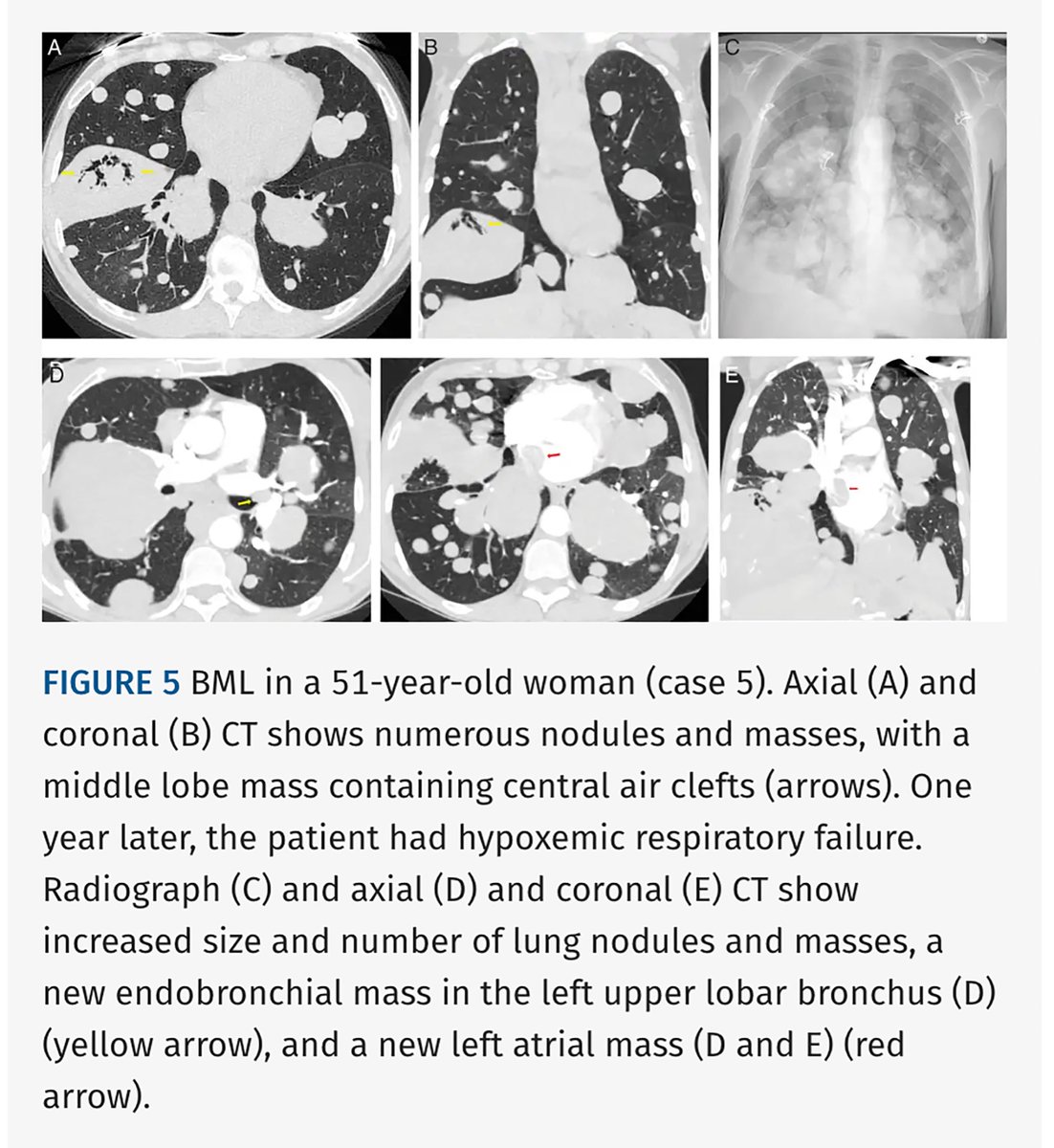 JTIJournal's tweet photo. 🫁 “Air-cleft sign” in pulmonary benign metastasizing leiomyomatosis, described by Diaz et al!

🔍 Seen in 6/7 patients
🩻 Smooth, crescentic, or oblong air clefts in larger solid nodules
🔬 Pathology: entrapped normal respiratory epithelium, not cavitation

Article 🔗 in reply! https://t.co/9ZDk9yAZ6q