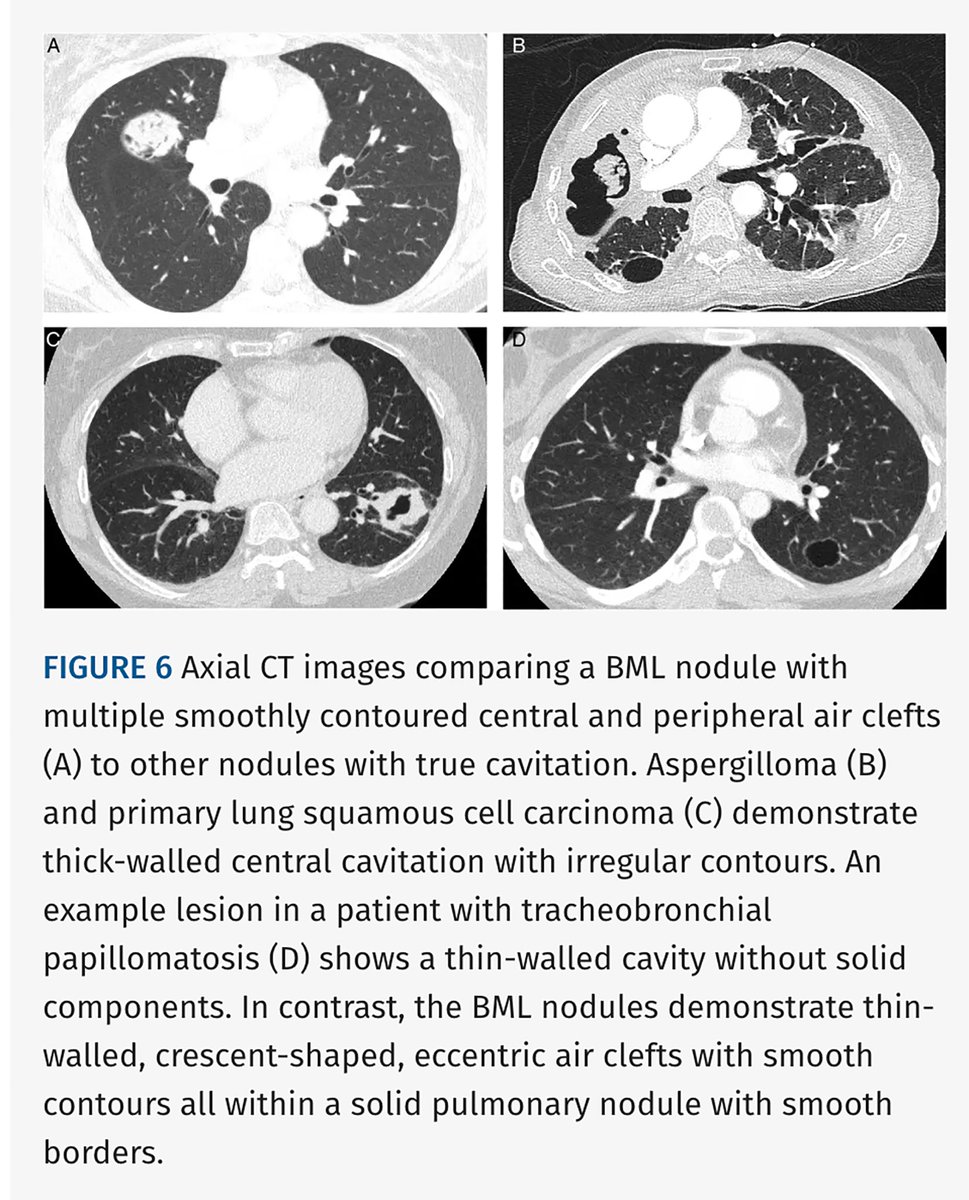 JTIJournal's tweet photo. 🫁 “Air-cleft sign” in pulmonary benign metastasizing leiomyomatosis, described by Diaz et al!

🔍 Seen in 6/7 patients
🩻 Smooth, crescentic, or oblong air clefts in larger solid nodules
🔬 Pathology: entrapped normal respiratory epithelium, not cavitation

Article 🔗 in reply! https://t.co/9ZDk9yAZ6q