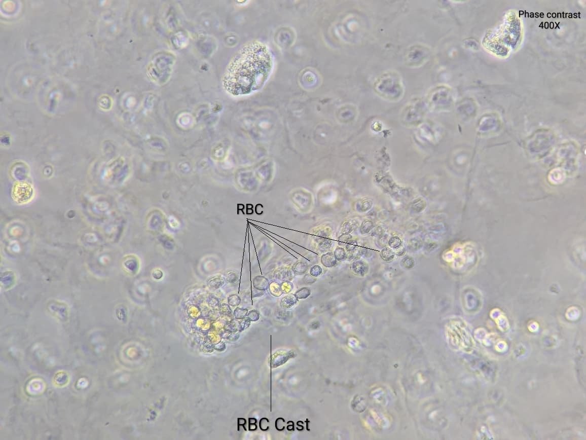 neph_ag's tweet photo. #UrinarySediment
47yo male patient with fever, bleeding due to orofacial granulomatous lessions and persistent microscopic hematuria. Cr 0.7mg/dL, c- and p-ANCA NEGATIVE #UrineMicroscopy shows acanthocytes, dysmorphic and WNC and RBC casts. https://t.co/W4xOtMdIhm