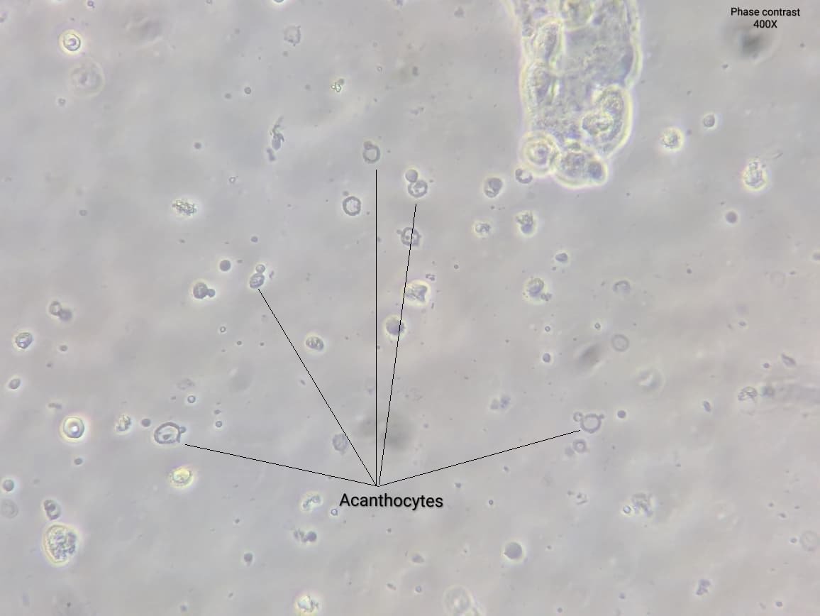 neph_ag's tweet photo. #UrinarySediment
47yo male patient with fever, bleeding due to orofacial granulomatous lessions and persistent microscopic hematuria. Cr 0.7mg/dL, c- and p-ANCA NEGATIVE #UrineMicroscopy shows acanthocytes, dysmorphic and WNC and RBC casts. https://t.co/W4xOtMdIhm