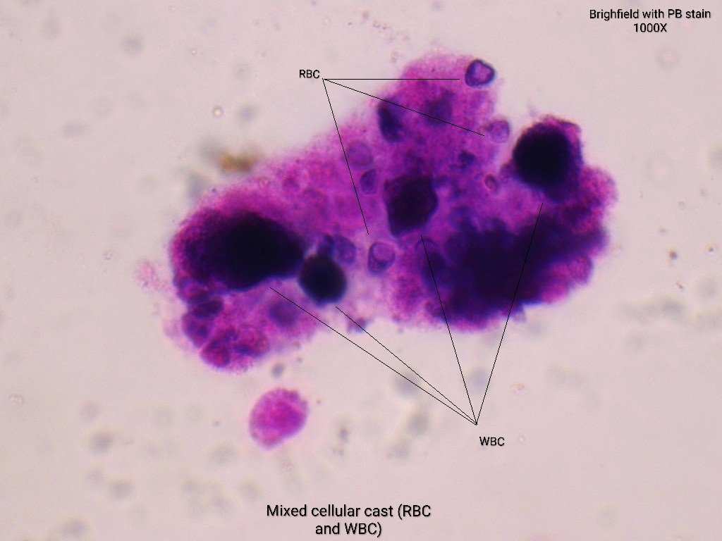 neph_ag's tweet photo. #UrinarySediment
47yo male patient with fever, bleeding due to orofacial granulomatous lessions and persistent microscopic hematuria. Cr 0.7mg/dL, c- and p-ANCA NEGATIVE #UrineMicroscopy shows acanthocytes, dysmorphic and WNC and RBC casts. https://t.co/W4xOtMdIhm