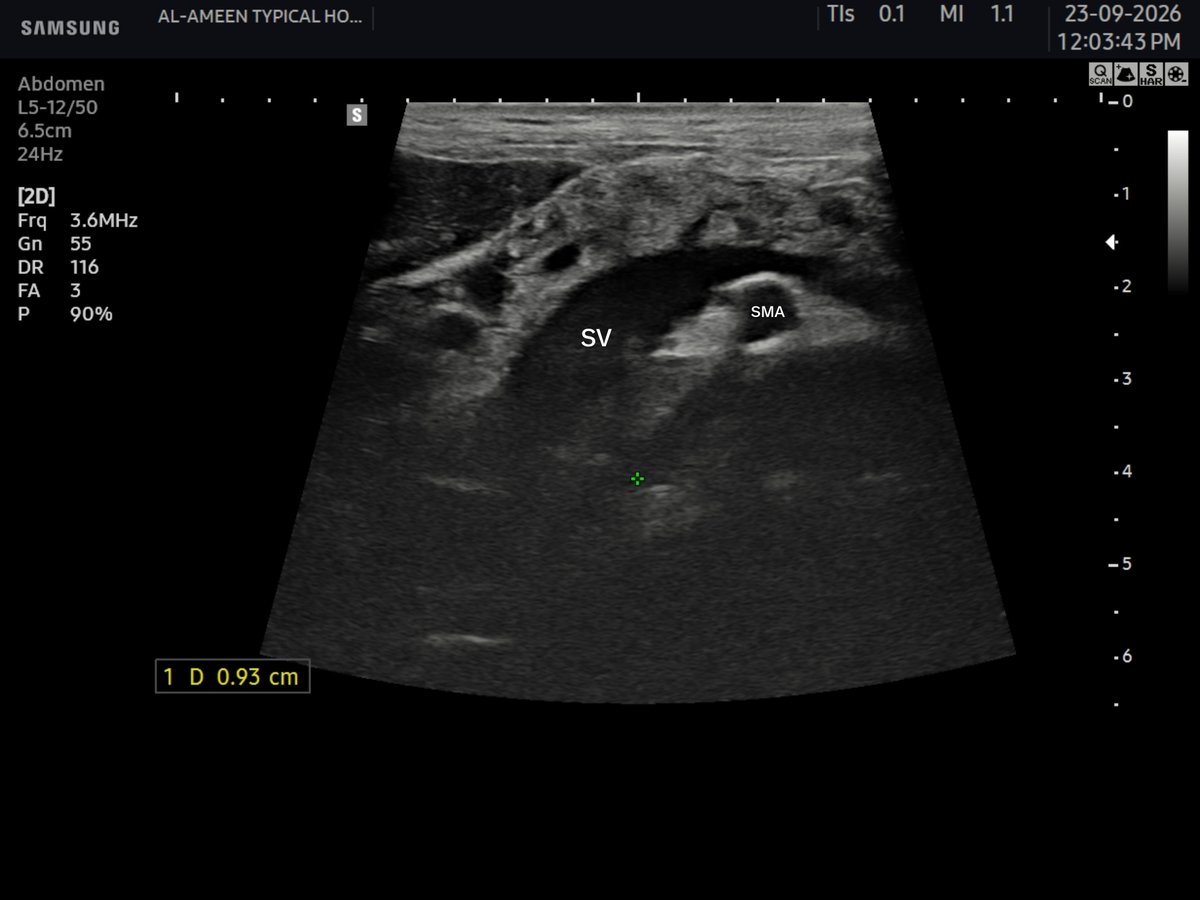 EchoTech_4's tweet photo. Acute pancreatitis https://t.co/o9gsclgD7I