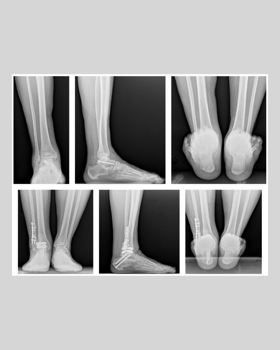 BoneJointJ's tweet photo. Achieving a plantigrade, neutrally aligned foot is essential for total ankle arthroplasty success, as malalignment is a major risk factor for early failure.

#AnkleArthroplasty #Arthroplasty #Surgery

https://t.co/2DUsuXOSu4 https://t.co/qunKmKd6fV