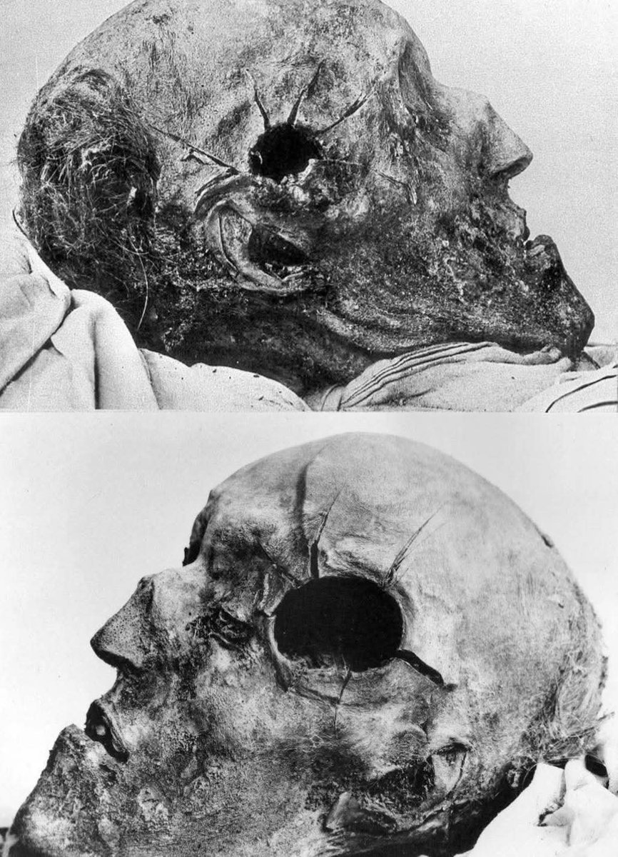 archeohistories's tweet photo. The head of the slain Swedish king Charles XII, killed in 1718 by a projectile while inspecting his troops’ lines during the siege of Fredriksten in Norway. The shot struck the left side of his skull and exited from the right. These photos were taken during a 1917 autopsy....  

Charles XII of Sweden was one of the last great warrior kings of Europe. His reign, stretching from 1697 until his death in 1718, was marked by the Great Northern War, a conflict that sought to secure Sweden’s dominance in the Baltic. Known for leading his armies personally and sharing the hardships of his soldiers, Charles embodied the ideal of the soldier-monarch. On a cold night during the siege of Fredriksten fortress in Norway, he rose from the trenches to observe his men’s positions when a projectile struck his head. The bullet entered from the left and exited on the right, killing him instantly. The event ended Sweden’s age of military expansion and ushered in a long period of decline.

Nearly two centuries later, in 1917, Swedish scientists exhumed the king’s remains to investigate persistent theories about his death — whether it was an enemy shot or an assassination by one of his own men. The skull’s damage, as seen in these photos, remains the centerpiece of that debate.

A lead button found near the wound during the autopsy fueled the belief that the fatal shot may have come from a Swedish musket rather than enemy fire.

#archaeohistories
