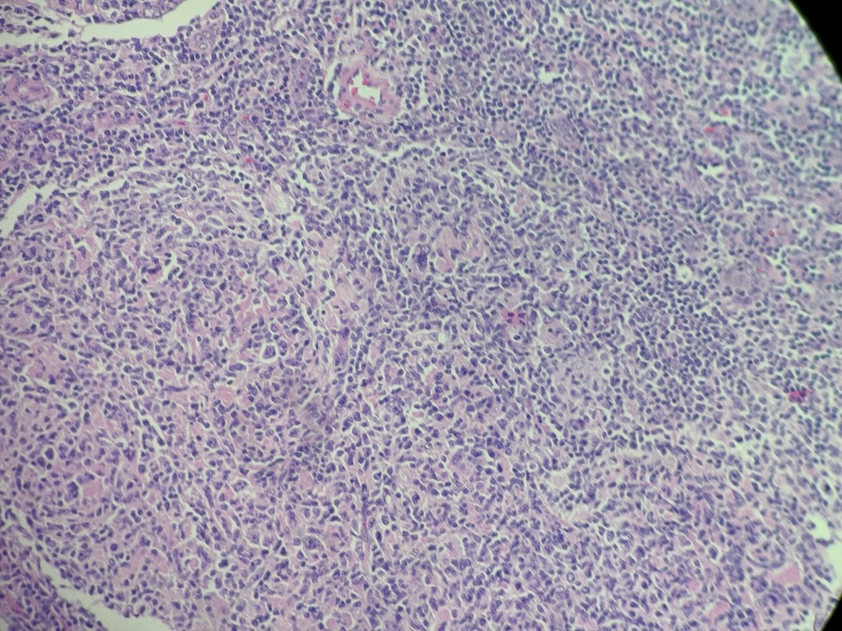 PathologyKate's tweet photo. Apparently you can have Reed-Sternberg like cells in Follicular lymphoma!?  The immunostain is CD30! https://t.co/3K8AdsbwJv