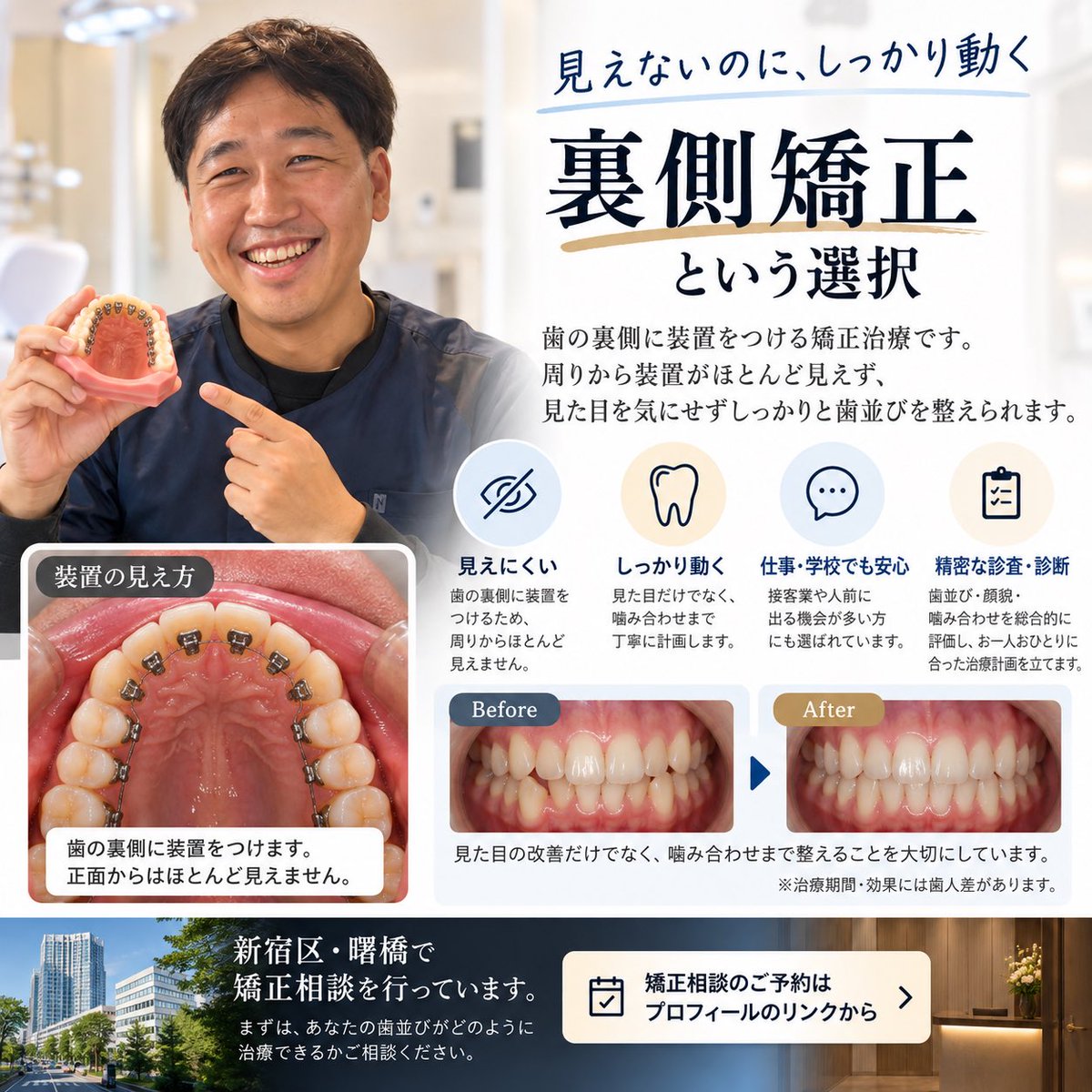 YYubutaka's tweet photo. 矯正したいけれど、装置が見えるのが気になる」

そんな方の選択肢のひとつが、歯の裏側に装置をつける裏側矯正（舌側矯正）です。

装置の種類だけでなく、歯並び・噛み合わせ・骨格を診査し、一人ひとりに合わせて治療計画を立てることが重要です。

新宿区・曙橋で矯正相談を行っています。

#裏側矯正 #舌側矯正 #新宿矯正 #曙橋

今回の画像なら、Instagramをメイン投稿