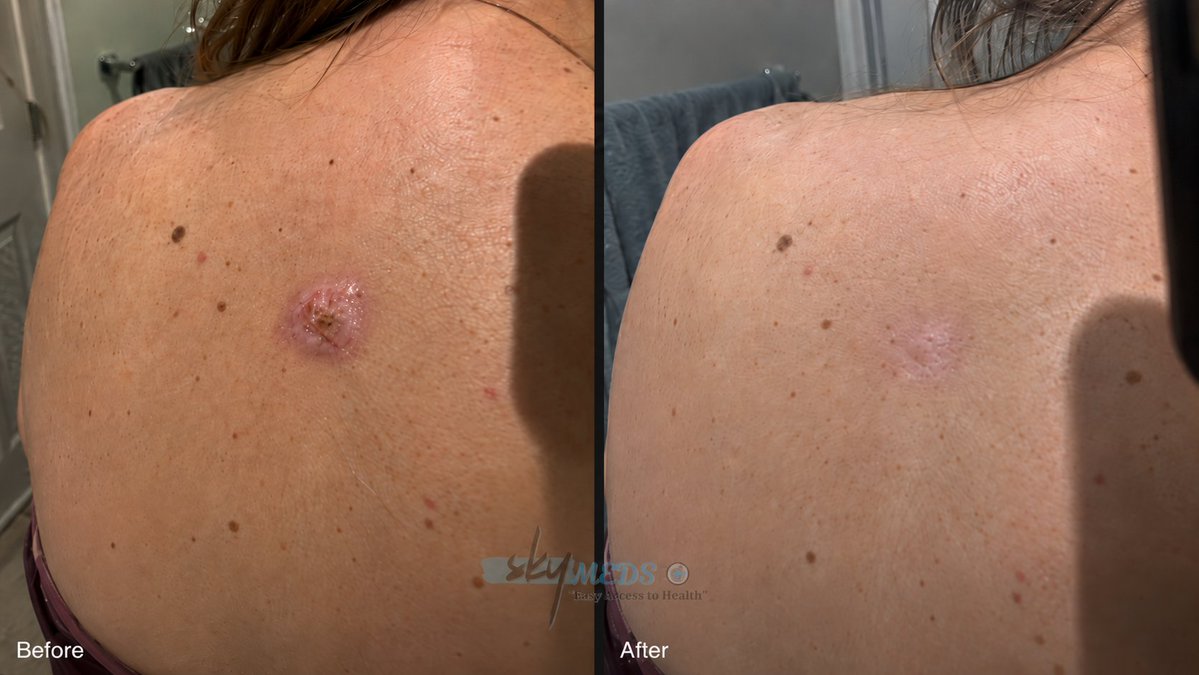 mycancerstorymm's tweet photo. She noticed it in the mirror. Right there on her back, just above her waist.

She was 58. She'd had moles her whole life. She knew her skin. But this one was different it had come out of nowhere, and it didn't look like anything she'd seen before.

Her husband looked at it. Said it was probably nothing.

She went to the dermatologist anyway.

Biopsy came back: basal cell carcinoma. The dermatologist said it was caught early and scheduled a Mohs procedure for six weeks out.

Six weeks is a long time to sit with something on your back.

She started reading. She'd always been the type. When her mother got sick, she was the one with the folder. When her husband had his heart scare, she was the one asking the cardiologist questions he didn't want to answer.

So she read. Late at night after he went to sleep. The same word kept showing up.

Ivermectin.

She was skeptical. Of course she was. She worked in accounting. She didn't believe in magic.

But she kept reading. People posting photos. People describing the exact thing she had a spot that crusted over and lifted and came off.

She bought a tube of the paste. Didn't tell her husband. Felt ridiculous doing it.

Week one: She applied a pea-sized amount every morning and night and covered it with a bandage. Nothing happened. The spot looked the same.

Week two: It started to itch. She almost stopped.

Week three: A crust formed. Dark. Dry. Scary-looking. She took a photo and showed it to nobody.

Week four: The crust lifted at the edges. She didn't pull it.

Week five: It came off in the shower. Underneath was pink, shiny tissue she'd never seen before.

Week six: She went to the Mohs appointment.

The surgeon examined her back and went quiet. Then he looked at the chart. Then he looked at her back again.

He asked her what she'd been doing.

She told him the truth. Every part of it. The tube, the paste, the weeks of watching.

He didn't lecture her. He didn't congratulate her either. He just said the margins couldn't be confirmed on a healed area, and he wanted to see her again in three months.

She said okay.

Three months later: Nothing came back. The spot was gone. The skin was smooth.

She still doesn't know if it was the paste. She'll probably never know. Her husband still doesn't know she did it.

But it's gone.

What she told me afterward:

"I'm not telling anyone to do what I did. I had a surgery scheduled. I had a backup plan. I wasn't stupid about it. But I also wasn't going to sit on my hands for six weeks and do nothing.

If I had a spot on my face and a doctor telling me it was fine, I'd still get the biopsy. I'd just also read everything I could while I waited.

I got lucky. I know that."

⚠️ Not medical advice this is one woman's experience, not a clinical trial. Do not skip a scheduled biopsy or surgery based on a story you read online. Talk to your doctor.