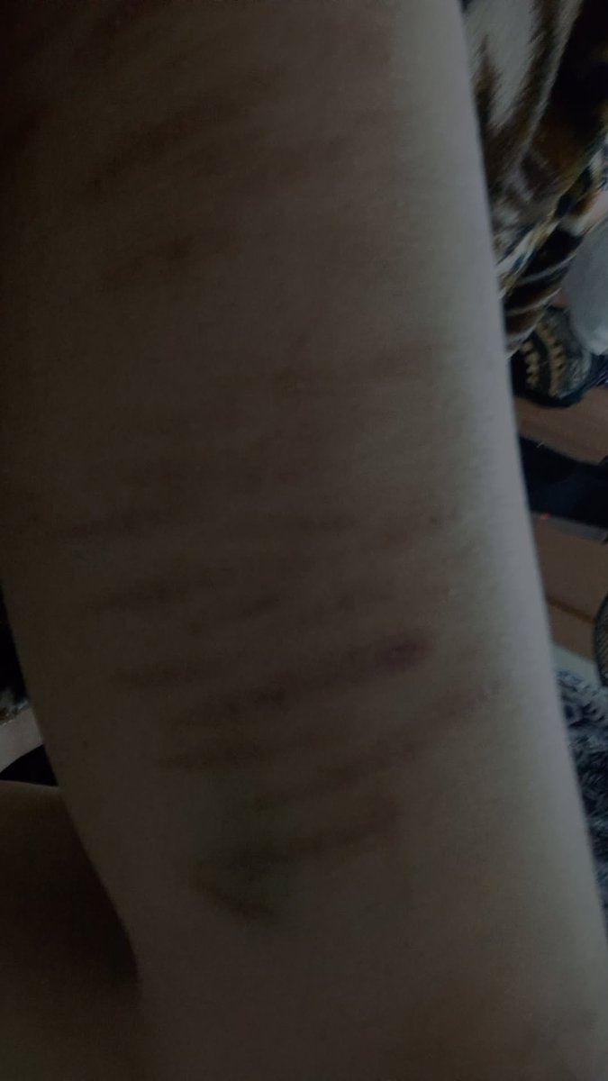 Cassie___twt's tweet photo. old healed scars and bruises
SFX MAKEUP PRACTICE 
FAKE FAKE FAKE
#shedtwt
#shtwt
#shrtwt https://t.co/J2QTRajo6L