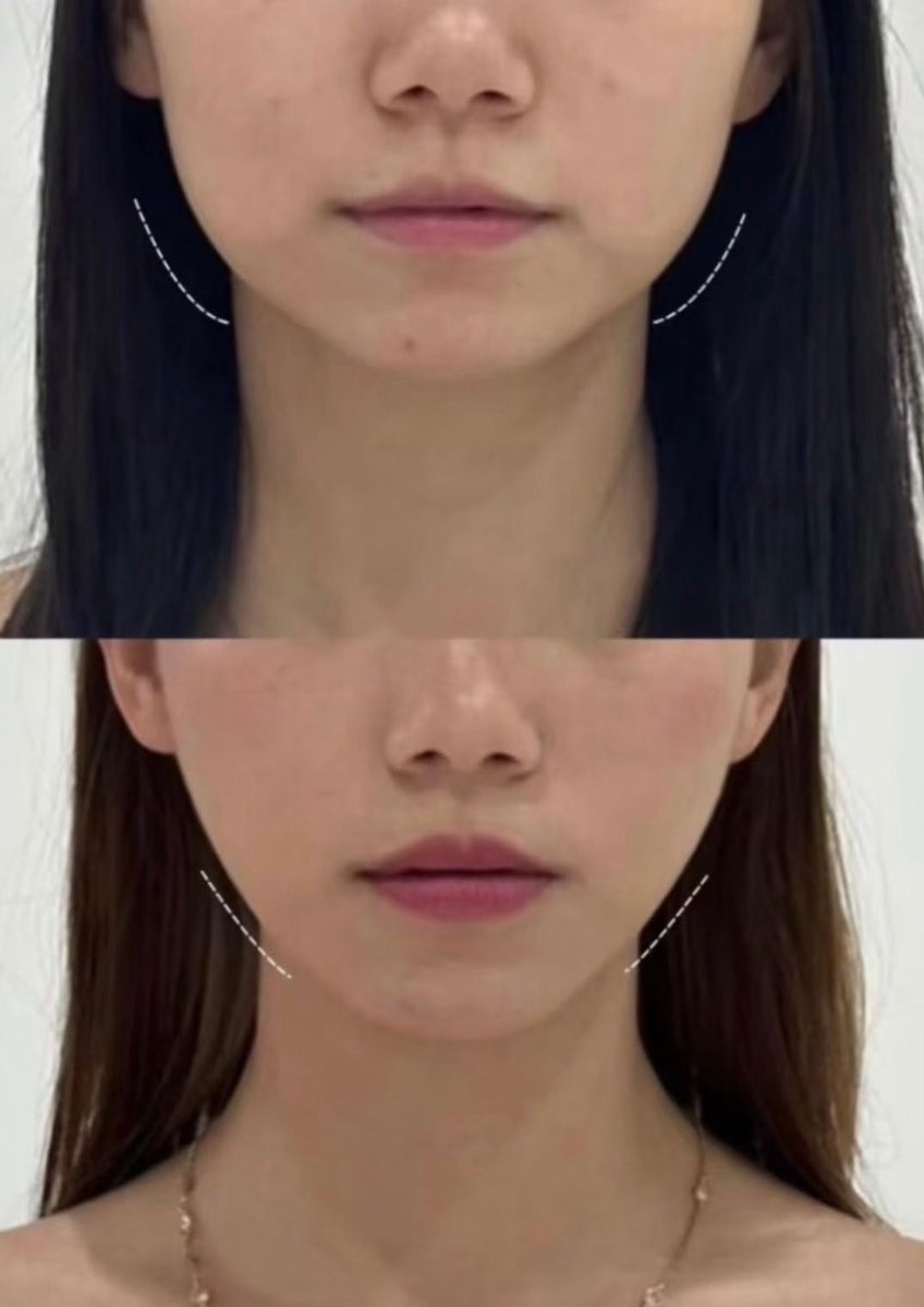 kao_yase_'s tweet photo. 口元のたるみにずっと悩んでたんだけど、これ寝る前にやったら2週間でここまで変われた😭 https://t.co/zoa4yg1fBW