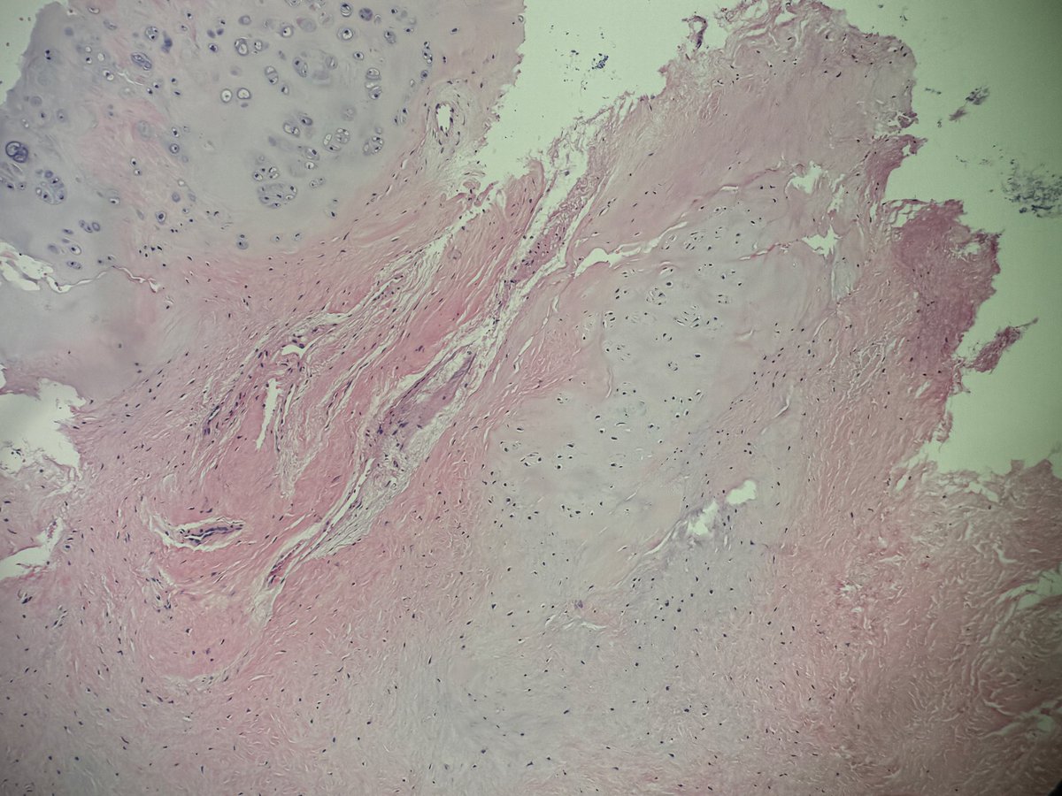 Andresangel3's tweet photo. #ENTPath #HeadNeckPath #Surgpath
60 yo man with 2 cm very hard mass in nose septum. Surgeon concerns about chondroma. I can see chondroid areas but what call more my attention is tremendous sclerosis. Any specific name for this https://t.co/quNVF3aUQd