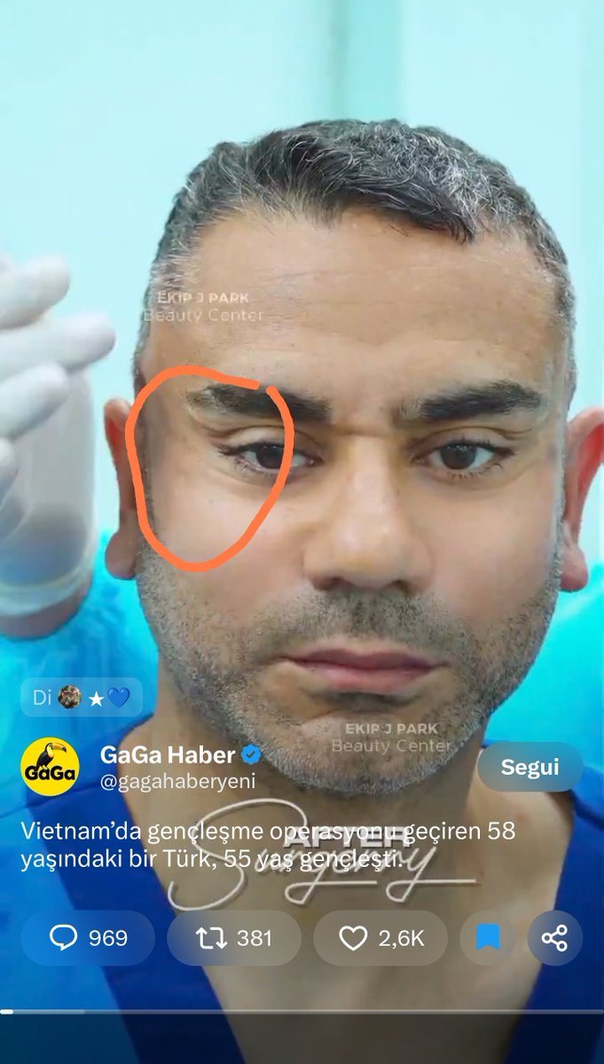 ActarusQ's tweet photo. @gagahaberyeni Questo rimane sempre così oppure cambia con il tempo? Si vede troppo che è stato tirato. Spero che poi si aggiusta. https://t.co/cBi0zj6r0Y