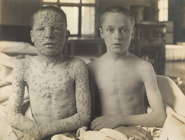 afrkml's tweet photo. Buat yg belum tau, dua anak ini sama2 kena cacar di tahun 1901.

Bedanya, yg kiri TIDAK divaksin sedangkan yg kanan sdh divaksin!

Wajah & seluruh badan anak yg kiri penuh bintil berisi nanah, khas gejala cacar smallpox pd saat itu. Sementara yg udh vaksin hampir gk ada gejala krn sistem imunnya udh kenal dg virusnya.

Untung cacar ini sudah MUSNAH. Ga ada lg cacar smallpox di dunia ini, thanks to vaksin.
Andai vaksin ga segencar itu, cacar bisa aja masih berkeliaran sampe saat ini.

Sekali kena, gejalanya parah banget hingga angka fatalitasnya lumayan tinggi.