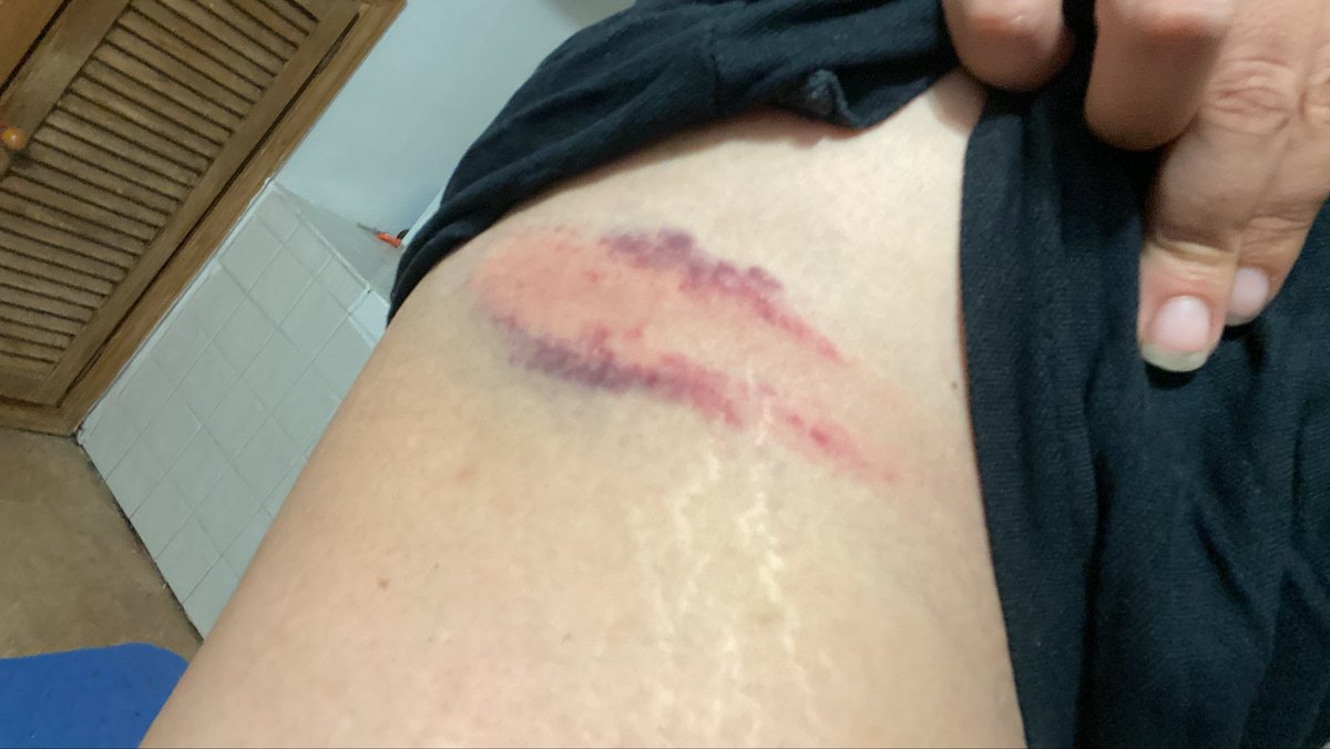 alemvelasco_'s tweet photo. Ayer cientos de personas fuimos gaseadas y golpeadas por la Policía Nacional. En mi caso, por documentar el desahucio de Maricarmen y la violencia policial contra quienes trataban de impedirlo. Sabemos que este es el precio por exponer sus crímenes. No dejaremos de hacerlo. https://t.co/Ex3spN7jji