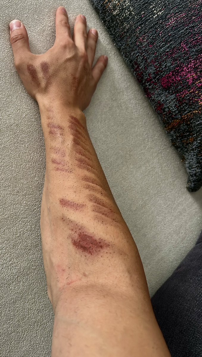 sinanerssoy's tweet photo. Epilasyon işlemi yaptırmak için gittiğim His Beauty Güzellik Merkezi’nde 2. derece yanık yaşadım. Önce karşı tarafla uzlaşmaya çalıştım.Hastane masrafı karşılanmasını, ücret iadesi ve sadece ödeme planı yazan haklarımın yazmadığı ve bir kopyasını vermedikleri sözde sözleşmenin+ https://t.co/v9HdSKthnW