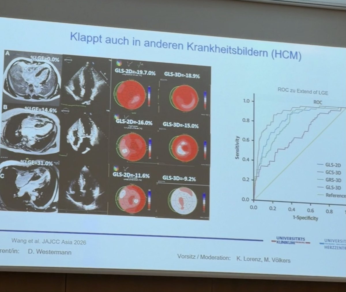 LukasHegerMD's tweet photo. Targeting Fibrosis in Heart Failure ❤️

Great early session #DGK2026HT: echo-derived GLS can help assess myocardial fibrosis. 📈Inspiring to see PIs driving the mechanistic insights on miRNA21 and EndMT toward clinical translation with startups and patents . 🔬➡️🫀@DGK_org https://t.co/0o77UIf0Bg