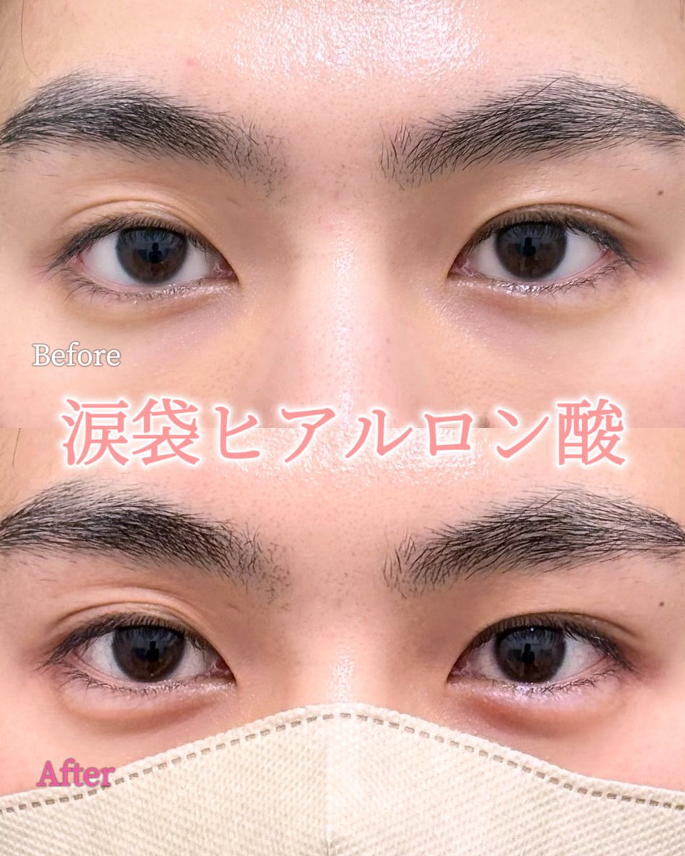 lula_hiroshima's tweet photo. メンズ大人気施術の涙袋ヒアルロン酸👀

お好きなデザインはカウンセリングで教えてください👂♪

#ルラ美容クリニック https://t.co/lFiU5Zbysz