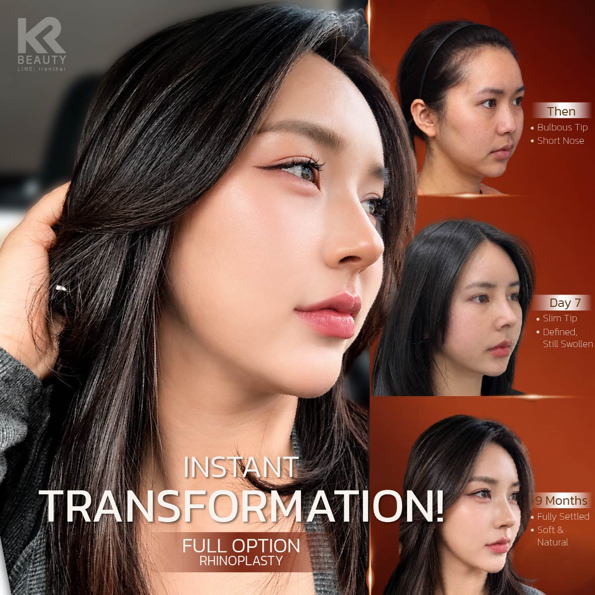 bananapsth's tweet photo. The ultimate glow-up!
Instant face transformation with our Full Option Rhinoplasty 💖

✅ 1:1 Consultation &amp; English Interpreter ✅ Airport Transfers ✅ Pre &amp; Post-Op Care
No stress or language barriers—just seamless recovery 💕
📱 Line: @ironthai https://t.co/PeGpnlVgck