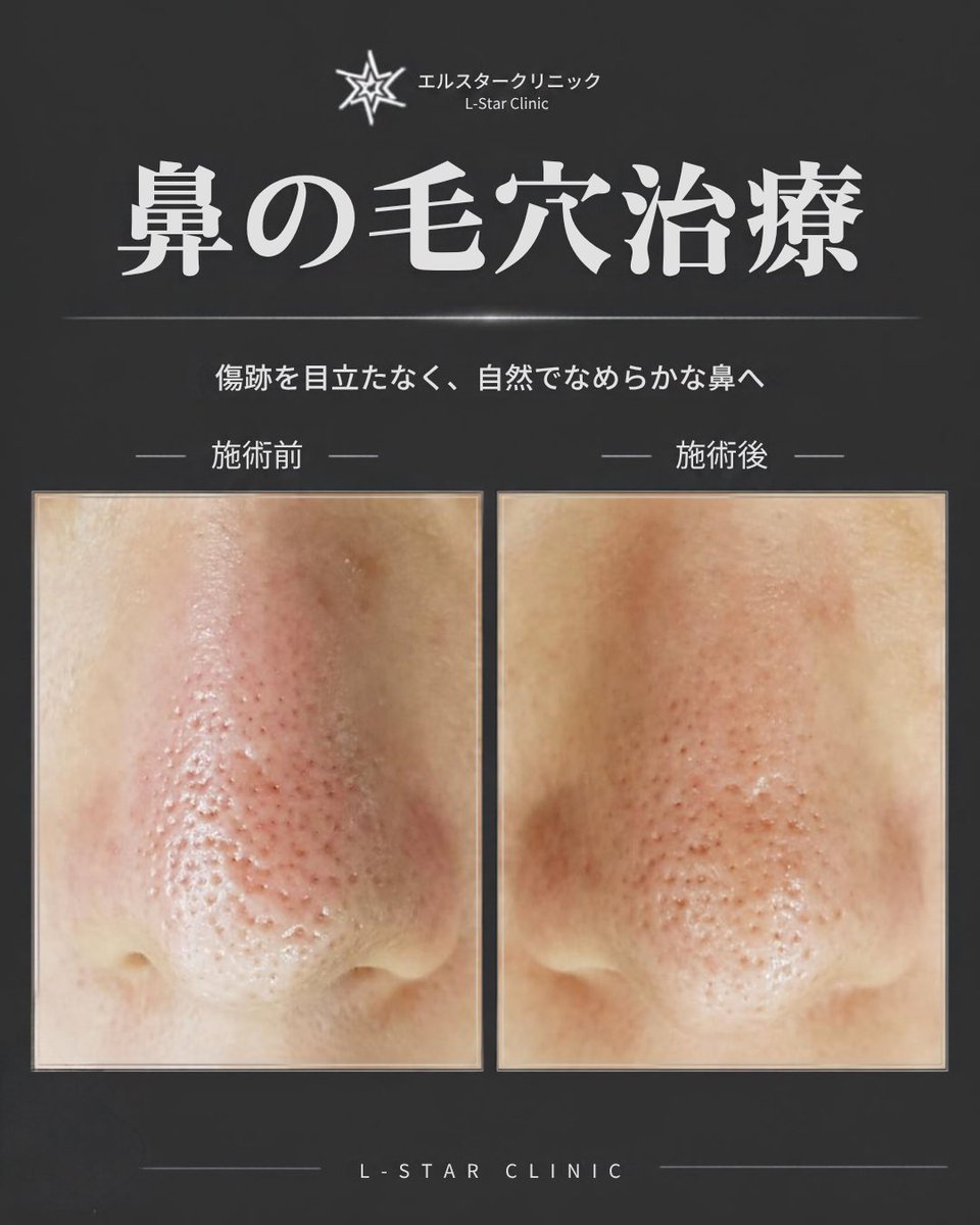 skinmaster0308's tweet photo. 【重度の鼻の毛穴と刺激による傷痕、2回の施術で滑らかに改善した症例】  

「長年、毛穴に悩まされて色々試してきましたが、本当に良くなるのでしょうか」  

ご来院された際、鼻の毛穴の開きが非常に重度な状態の患者様でした。

毛穴の凹凸が傷痕のように見えるほど鼻の皮膚に過度な刺激が加わっており、皮膚組織がかなり傷んでいる状態でした。  

毛穴治療を2回終了した段階ですが、施術後の赤みが強く見られたため、現在は赤ら顔治療を並行して行っている最中です。  

[施術前の状態]

小鼻の側面から鼻先にかけて、毛穴が非常に大きく開いていました。

特に右側の小鼻周辺の毛穴の落ち込みが深く、全体的に凹凸と赤みが目立つ状態でした。  

[2回の治療後の変化]

施術前の写真と比較すると、顕著な変化が見られます。  

 凹凸が目立っていた毛穴の境界線が滑らかになり、全体的な肌の質感が柔らかくなった  
 深く開いていた毛穴の大きさが縮小し、肌のキメが整った  
 写真で直接比較したことで、患者様ご自身も大きな変化に驚かれ、非常に満足された  

[治療のポイント]

毛穴のお悩みが深刻な方ほど、普段から鏡を見るのを避けたり写真を撮られるのを嫌がる傾向があります。

そのため、実際に肌が改善していてもご自身では変化に気づきにくいことが少なくありません。  
しかし、治療前後の写真を見比べると確実に良い方向へ変化していることが分かります。
個人の皮膚再生力によって改善の速度や程度に差はありますが、適切な施術を行えば必ず効果が現れます。  

なお、酒さ（赤ら顔症状）を伴う場合は、毛穴治療と同時に赤みの治療を適切に組み合わせることが重要です。
あきらめずに正しいケアを続けることで、滑らかな肌を取り戻すことができます。 

#鼻の毛穴 #毛穴の開き #毛穴改善 #毛穴治療 #赤ら顔 #皮膚再生 #韓国整形 #渡韓整形 #美肌治療 #韓国美肌 #肌質改善 #トーンアップ #肌再生 #韓国美容 #美容皮膚科 #毛穴ケア
#エルスタークリニック