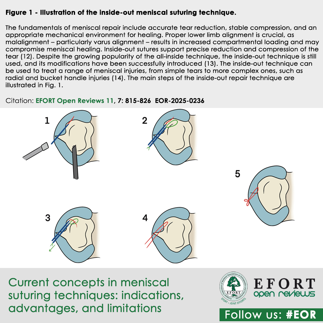 EFORTnet's tweet photo. #PreservedMeniscus vital for #JointHealth! #RepairTechniques
π§΅ Inside-Out PreciseStrong need #AccessoryIncision
π§΅ Outside-In standard 4 #AnteriorHornTears
π§΅ All-Inside Fast ideal 4 #PosteriorHorn
#ACLRpairing when #BoostedBiologicHealing
π https://t.co/2TCliJdBoV
#EFORT #EOR https://t.co/SWkJxbKiry