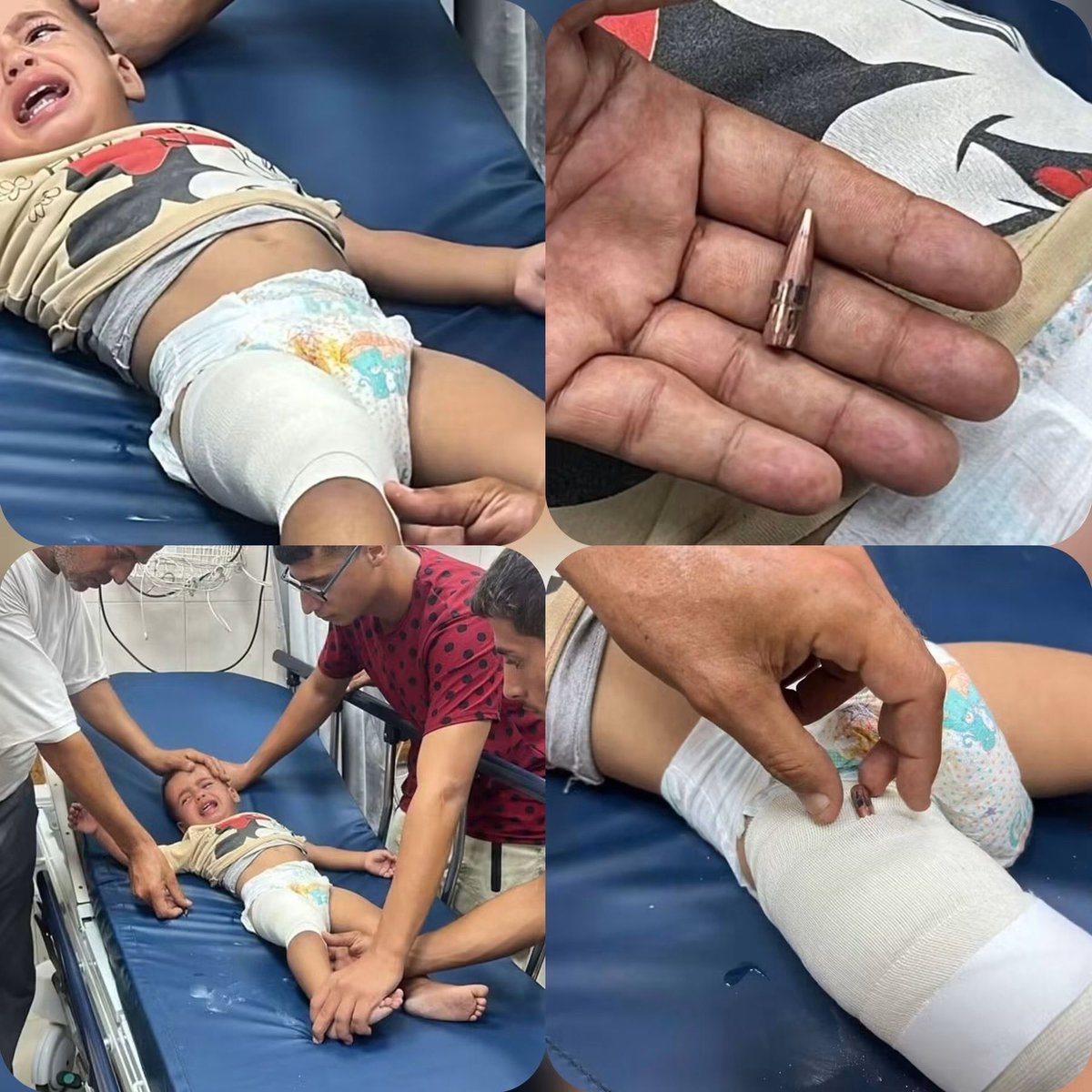 AhmedAAshour8's tweet photo. Just one year old and an Israeli bullet pierced his leg 💔

One-year-old Ibrahim Zannoun arrived at the hospital today after being shot in the leg by Israel

Ibrahim does not know what war means, nor does he understand why children carry pain instead of toys All he knows now is a pain greater than his age

Israel is committing genocide in Gaza