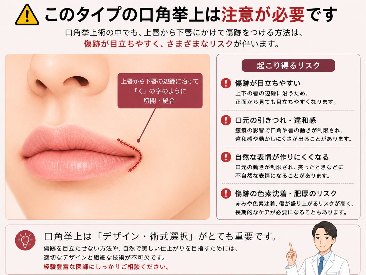 prism_morimoto's tweet photo. 「口角挙上は傷跡が目立つ」

と一括りにされることがありますが、一部の術式やドクターによる技術で大きく変わります。

今回の症例は、私が行っている口角挙上・全層法。

口角の形だけではなく、傷跡まで含めてデザインしています。

術後の傷跡がどのように経過するのか。
↓ https://t.co/3ghYOZi2rd