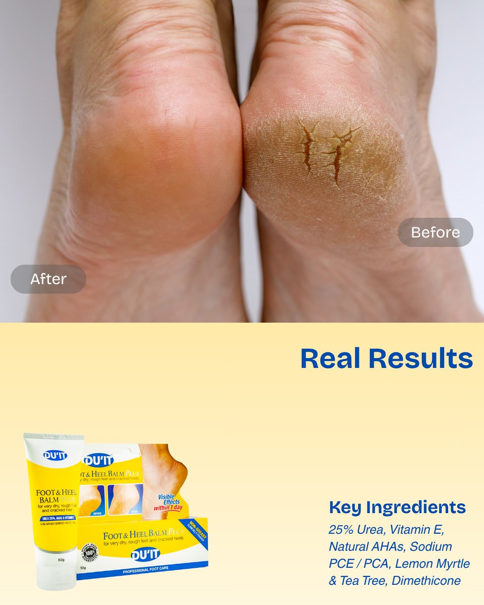 DenishaKopkb's tweet photo. Rough, dry, painful heels? It’s more than dryness—it’s damaged skin. With 25% urea, our Foot &amp; Heel Balm Plus helps seal cracks, deeply hydrate, and restore softness, with visible improvement in just 1 day. https://t.co/zyKYSuaLP5