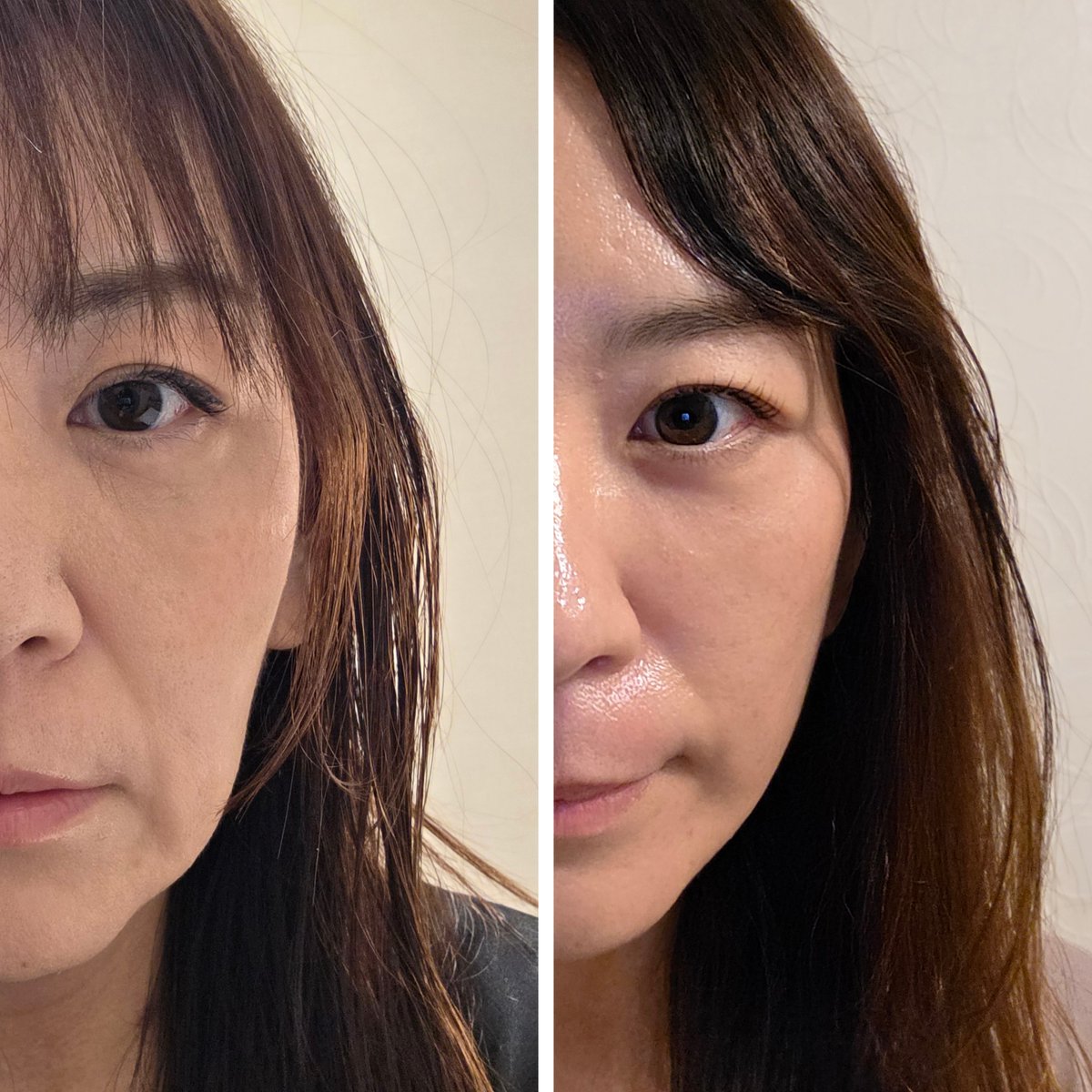 mumumolulu's tweet photo. ま、さ、に、それ！術後ムンクの叫びみたいな頬コケがなくなったし四角い輪郭も改善され小顔になった���！そしてこの前言ってた目頭下の縦ジワこの写真のほうがわかりやすい！before老けすぎw チャンナム先生目元の手術も得意みたいで眼瞼下垂のもお願いしたくなってる笑
📍リネ美容外科（rinejpps） https://t.co/s9GkKaXQ4h