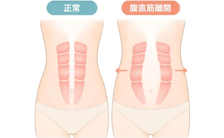 IseharaSwitch's tweet photo. 【産後のお腹のたるみ、努力不足ではないかも】

産後のお腹のたるみは、妊娠に伴う #腹直筋離開 が関係している可能性があります

✅ 腹直筋離開が起こる仕組み
✅ セルフチェックの注意点
✅ 運動再開の判断軸
✅ 医療機関へ相談する目安
などを整理しました👇 https://t.co/zWmcJiqVGd