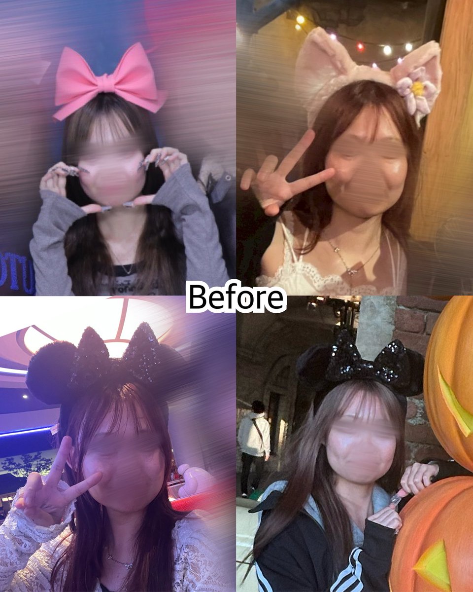 6a6y11_'s tweet photo. シャープ美容外科（@sharpps_jp）で目の下脂肪再配置、脂肪吸引、糸リフト、ボトックス、脂肪移植、バッカルファット、スキンボトックス+PRP をして1週間経ちました🪽これからさらに腫れが引いていくのが楽しみです✨引き続きレポしていきます♩ https://t.co/adFiKVsSVW