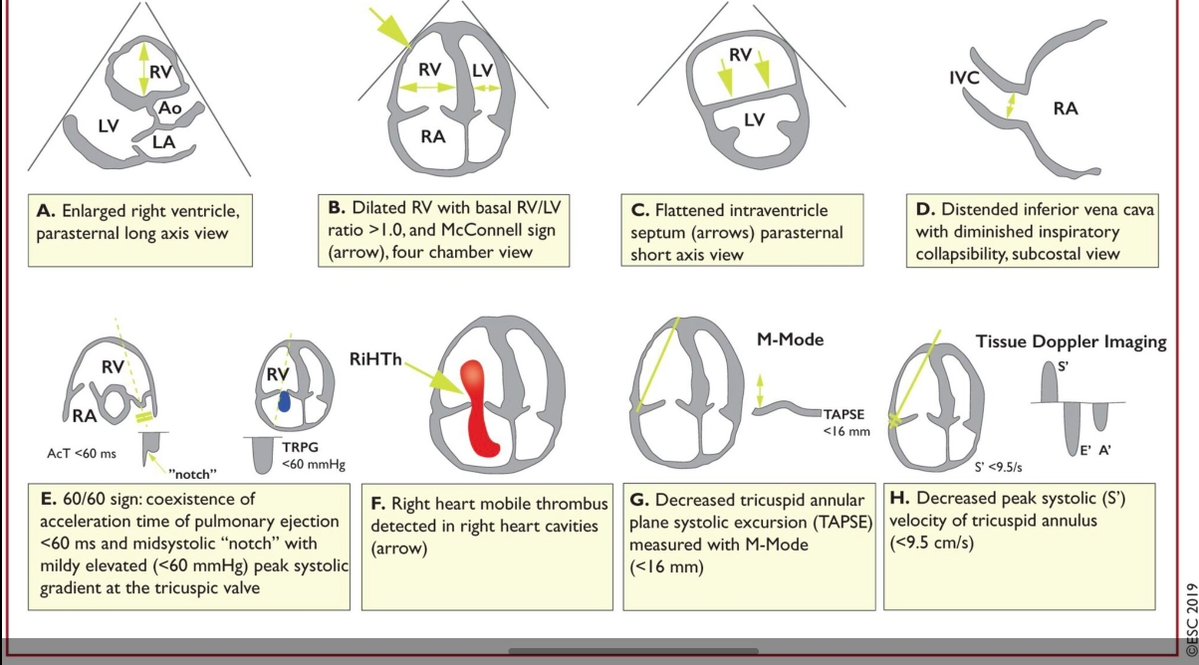EveryOneNoOne1's tweet photo. Delighted that our @POCUSUK systematic review & meta-analysis on the diagnostic accuracy of focused TTE in acute PE has been accepted for publication @EJEMedicine @EuroSocEM
Building on @escardio PE guidelines, this provides up-to-date evidence
#POCUS #MedTwitter #FOAMed https://t.co/Q5tmgLPgDt