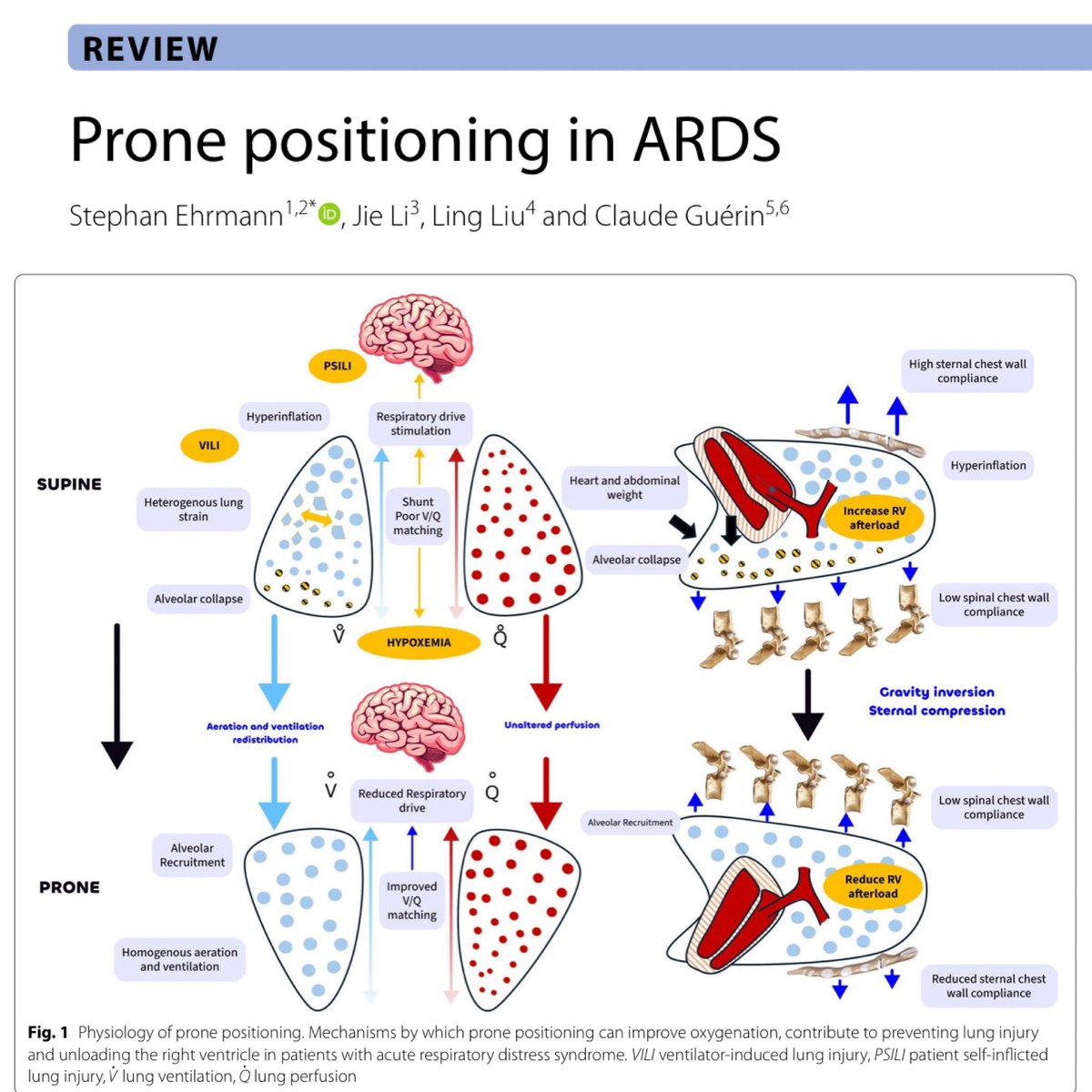 eddyjoemd's tweet photo. Has it been a while since you read a proning article? Yea, same here. Here’s a good refresher on the data for you and your team. 🎩 tip to the authors.
https://t.co/sSr8PFzSBW https://t.co/kiLl6dugKl