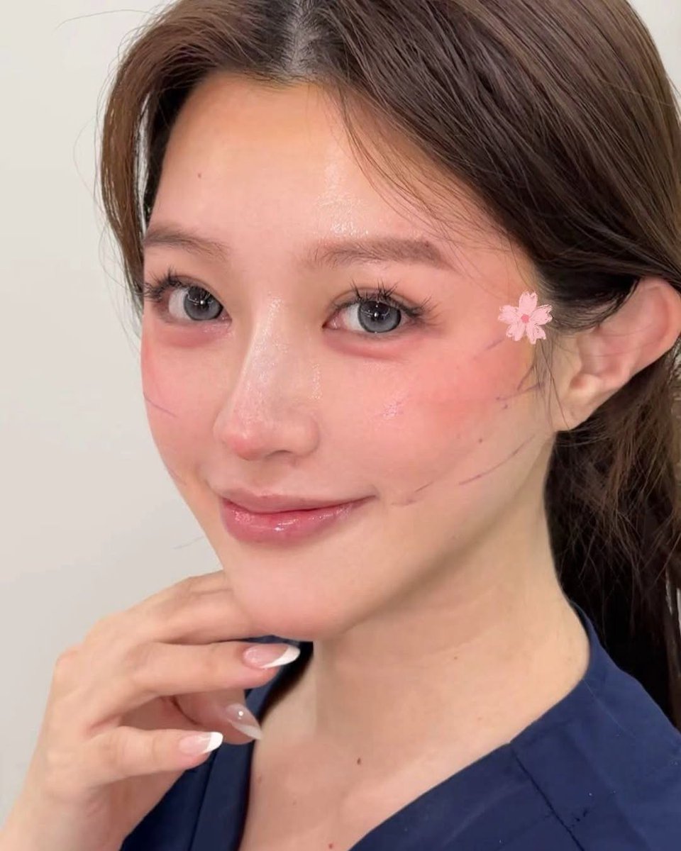 malkymacaulay's tweet photo. This young woman from Taiwan came to Shanghai to see Dr. Xiao. A customized 9D facelift improved facial laxity, cheek descent, deep folds, and jawline definition, delivering a natural, refreshed, more youthful look. https://t.co/ChEDKlyRir