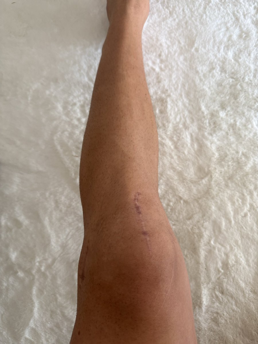 sergi5brunet's tweet photo. 177 días después, vuelvo al césped.

He llorado, dudado y sufrido, pero nunca estuve solo. Gracias a todos los que me levantasteis cuando caí.

Salí lesionado. Vuelvo de pie. Y vuelvo con hambre.

Algunas historias no terminan con una lesión. Empiezan después.💪🏻⚽️ https://t.co/hf5V49OqEB