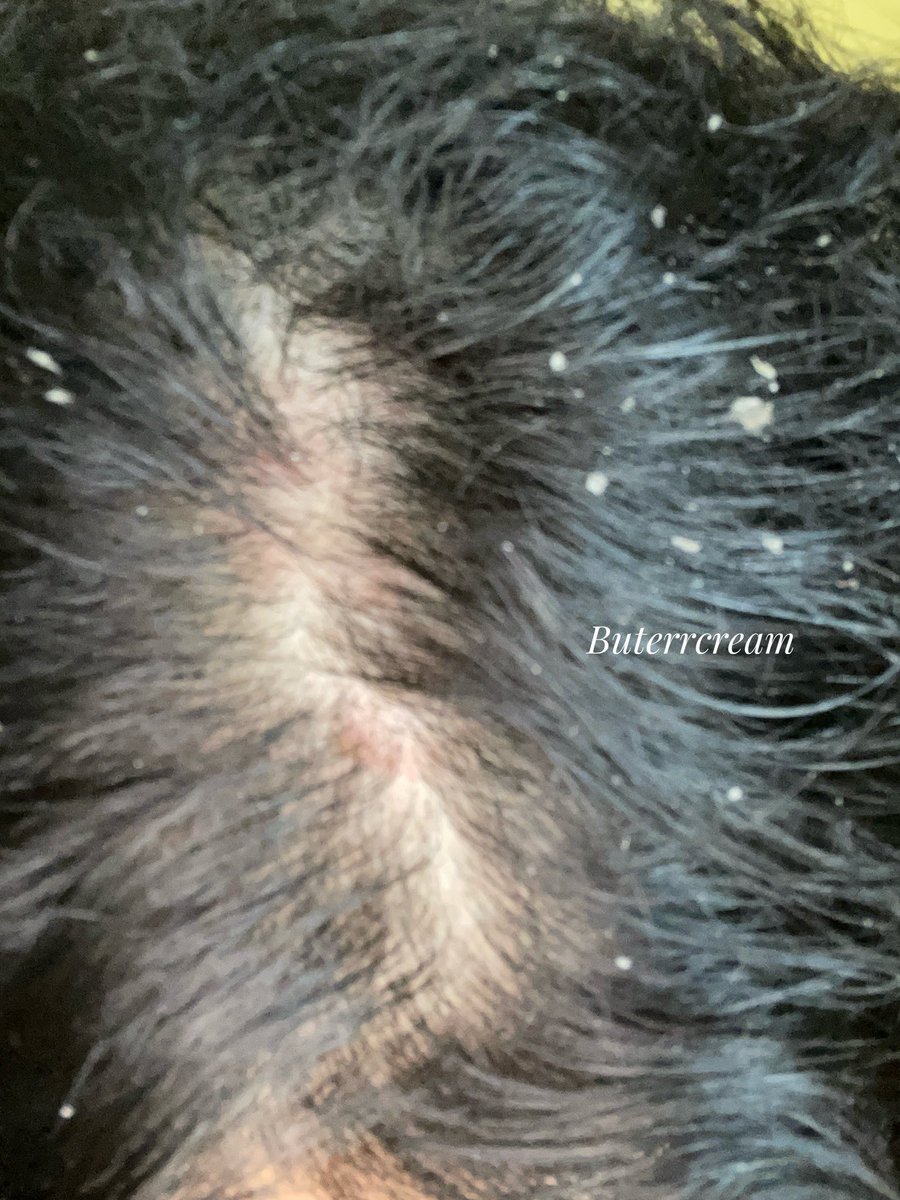 Buterrcream's tweet photo. WOIII… KENAPA BARU TAU HACKS INI SEKARANG SIHHH?!!😭
Padahal cuma ngelakuin cara ini, ketombe sama rambut lepek aku yang udah bertahun-tahun langsung membaik dalam 3 hari!! https://t.co/m9jPiXyE8L