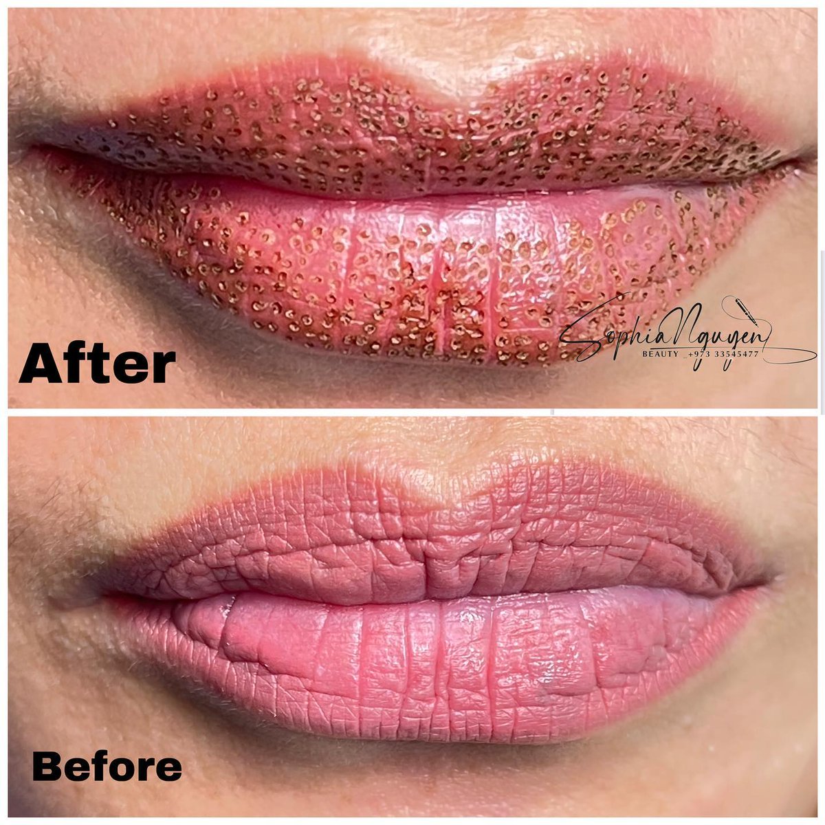 evertomsr's tweet photo. Remove excess skin, tighten, and rejuvenate lips with plasma fibroblast technology. https://t.co/XA6IYg5eDW