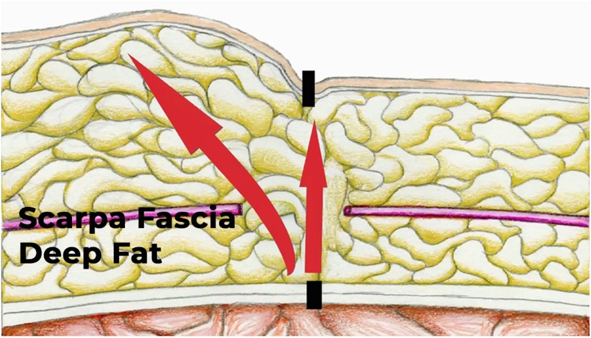 AJOG_thegray's tweet photo. AJOG Expert Review in Cesarean: The cesarean apron: description, proposed pathophysiology, classification, and prevention through scarpa fascia closure at cesarean delivery - Proposed pathophysiology of the cesarean apron. https://t.co/WQ5HvAclUz https://t.co/AnHjlK8Wg9