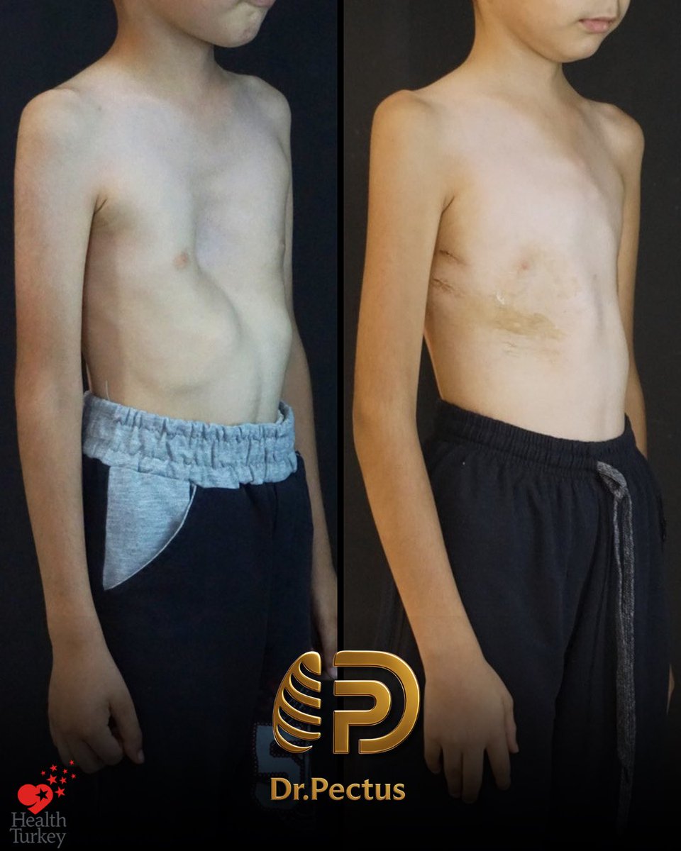 drpektus's tweet photo. 🩺 From Vacuum Bell to Nuss: a step-by-step treatment journey…

Our patient first presented to our clinic in August 2023 for follow-up of Vacuum Bell treatment that had previously been initiated at another center for Pectus Excavatum.

#pectusexcavatum #nussprocedure https://t.co/MndmZ1ZZIH
