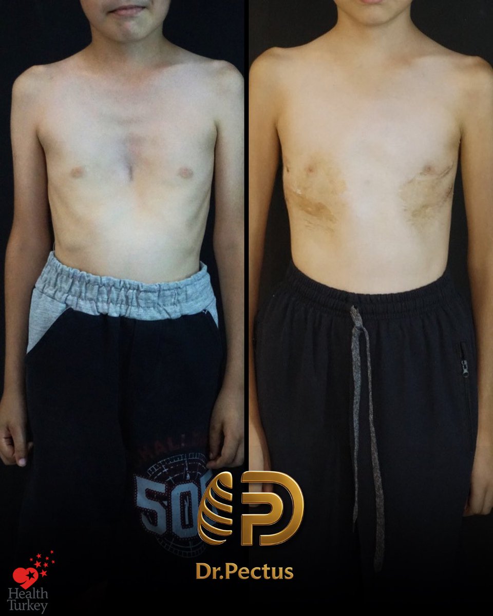 drpektus's tweet photo. 🩺 From Vacuum Bell to Nuss: a step-by-step treatment journey…

Our patient first presented to our clinic in August 2023 for follow-up of Vacuum Bell treatment that had previously been initiated at another center for Pectus Excavatum.

#pectusexcavatum #nussprocedure https://t.co/MndmZ1ZZIH