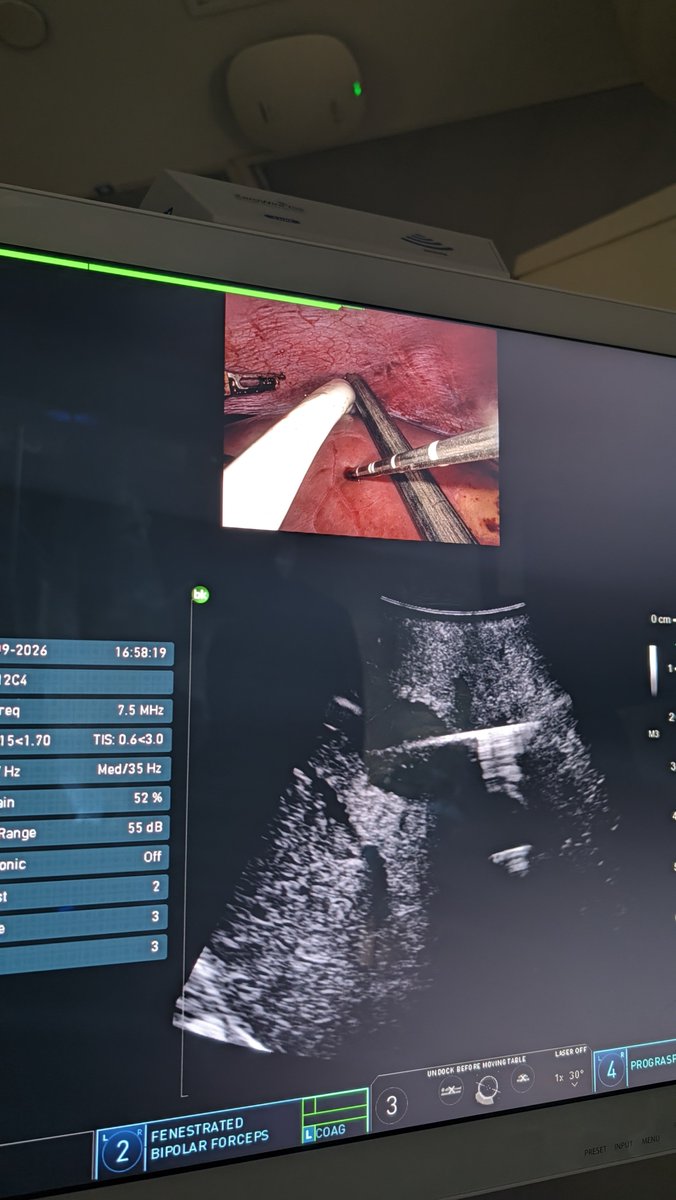 Robo_HPB's tweet photo. Microwave Ablation of 1.7cm CRLM during robo LAR. Joint cases (although a hassle for surgeons at times) save patients extra procedures, time, money. Safety is priority but wherever possible, with together! #teamsport https://t.co/8cLqnj8TyV
