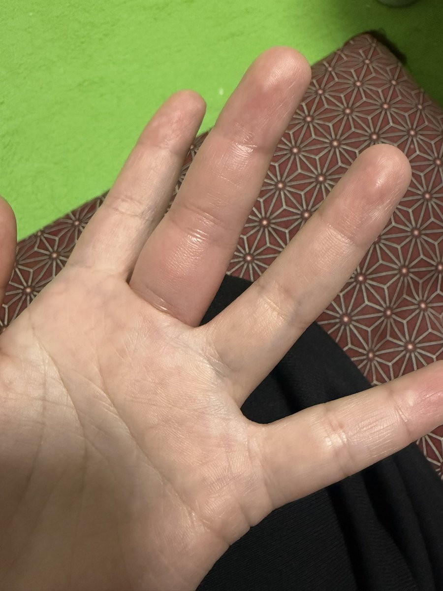 chicchi_511's tweet photo. 帰りドンキ寄ったら急に痒くなってきて、見たら中指がパンパンになってた
指が曲げられなくて痛いくらいやばかった…(画像はだいぶ引いてる)
そしてさっき家の中で首におしり周りがでかくなってるアリが歩いてて叫んだ…
今年あんまいい年じゃないのかも？？
怖すぎ〜😭😭助けて笑 https://t.co/gTqxvuah4P