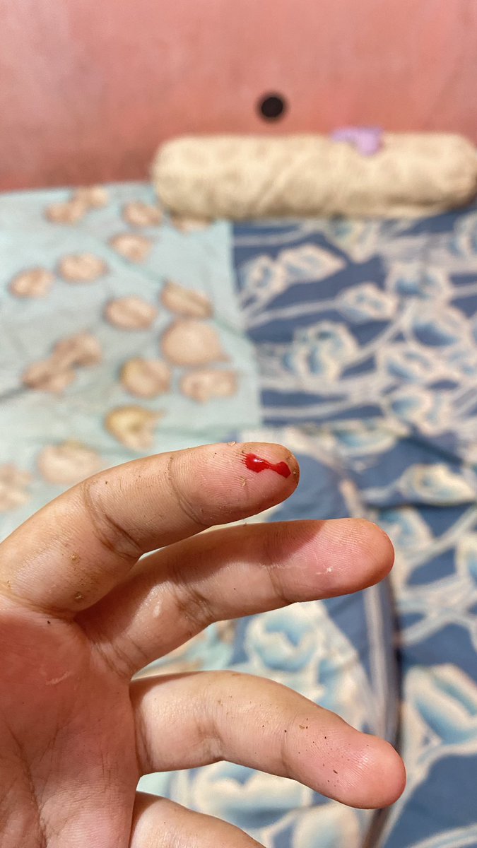urguiltyplsure's tweet photo. dari sekian kali masak baru kali ini beneran luka wkwk https://t.co/jYcCm5Kg0Q