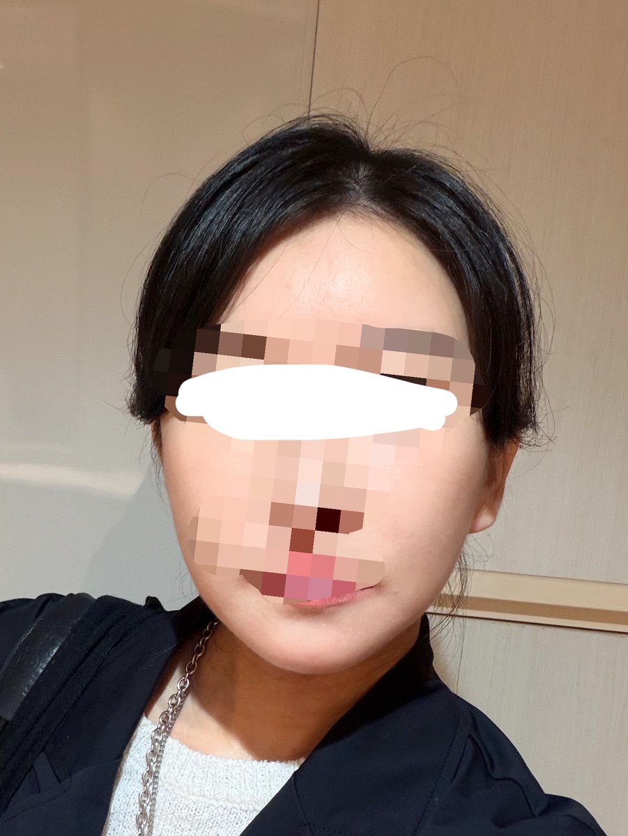toushitobiyou's tweet photo. どっちもノーマルインカメ📸
もしかしてオンダリフトめっちゃ効いてる？
頬コケのミヒ注射も意味あったかも😅 https://t.co/4AUe5hrUco