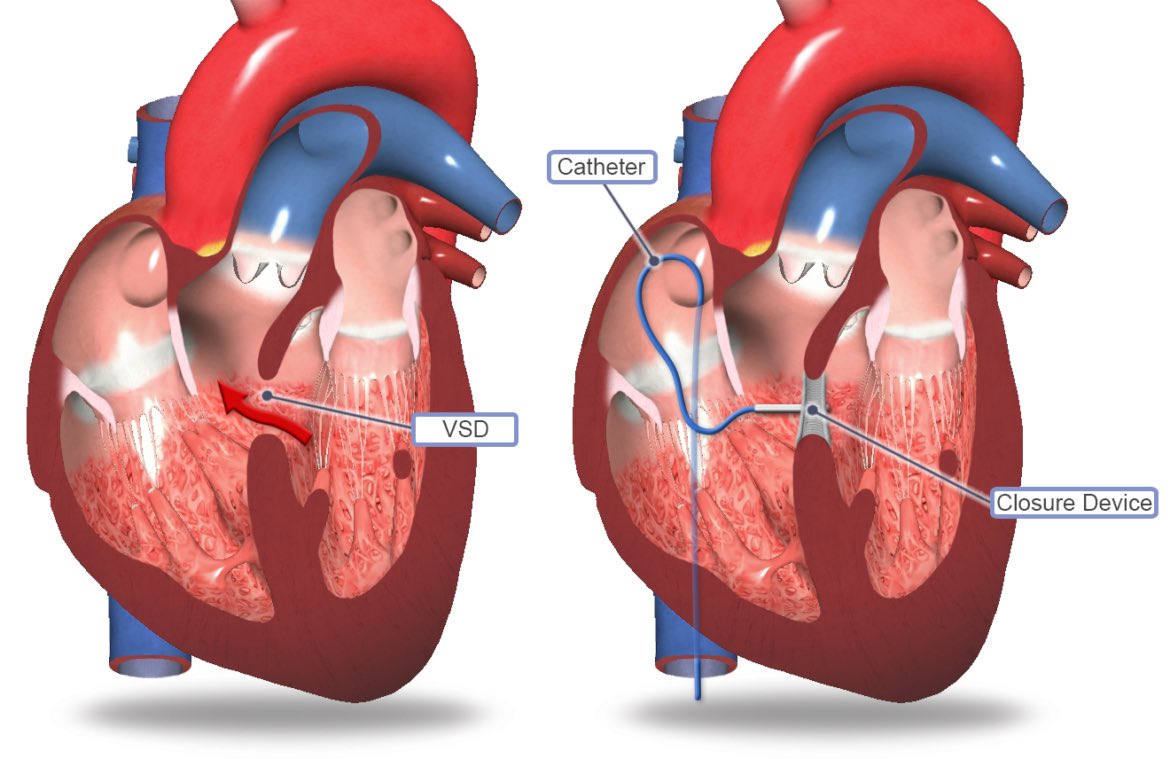 eodanielmd's tweet photo. 🫀 When NOT to close a VSD:

🚫 Eisenmenger physiology (Class 3: Harm)
🚫 Nonrestrictive VSD w/ PVR >10 WU — prohibitive surgical risk
🚫 Qp:Qs <1.5 &amp; no other indication (Class 3: No Benefit)
⚠️ PVR 5–8 WU = gray zone → treat-and-repair, close only if PVR <5 WU

#cardiorounds https://t.co/Y1nBj639h8