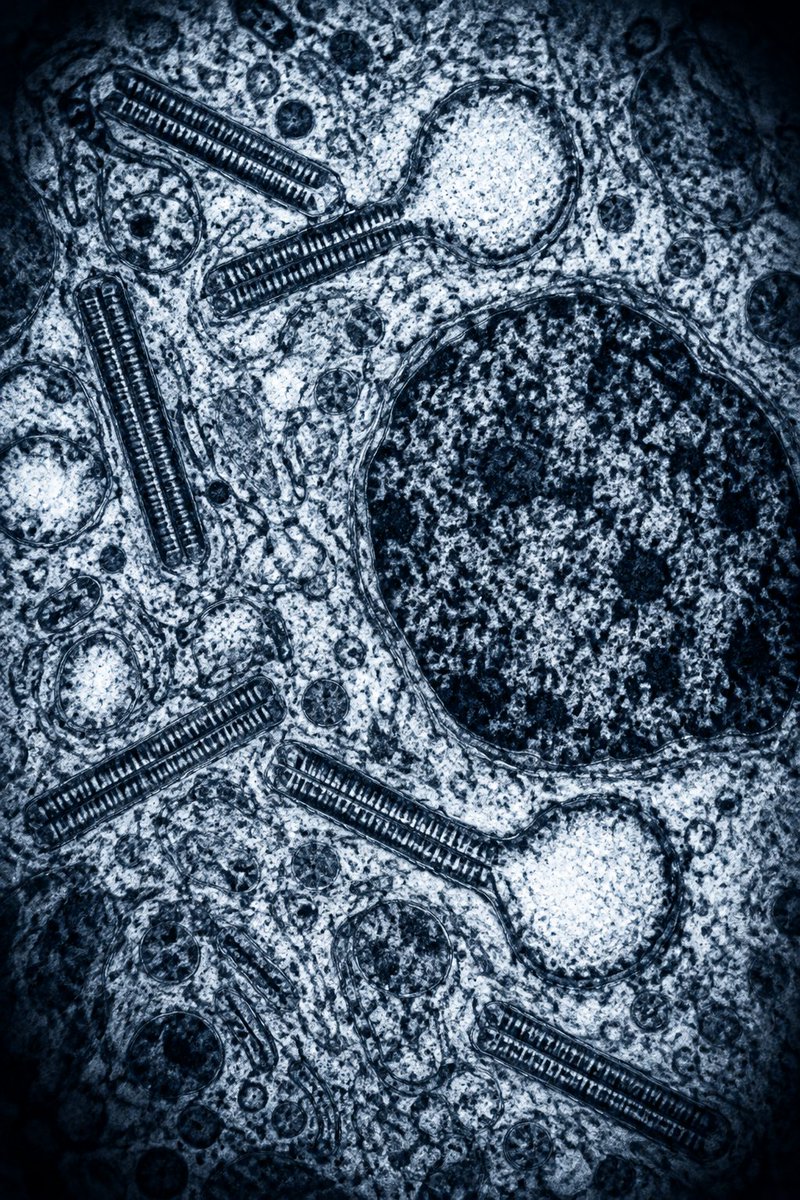 IhabFathiSulima's tweet photo. A characteristic “tennis-racket” cytoplasmic organelle is identified on electron microscopy.

In which condition is this finding classically seen?

A. Malignant histiocytosis
B. Langerhans cell histiocytosis
C. Juvenile xanthogranuloma
D. Niemann–Pick disease https://t.co/9RogmFXZ5x