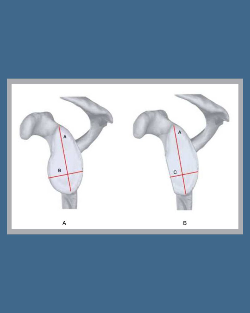 BoneJointOpen's tweet photo. The degree of glenoid bone loss in recurrent anterior glenohumeral joint dislocation affects the ongoing management and therefore accurate measurement of this is important.
#ShoulderDislocation #BoneLoss #Orthopedics @DuncanTennent @OrthoGeorgePods
https://t.co/afoHRtqrIn https://t.co/437HonxaT8